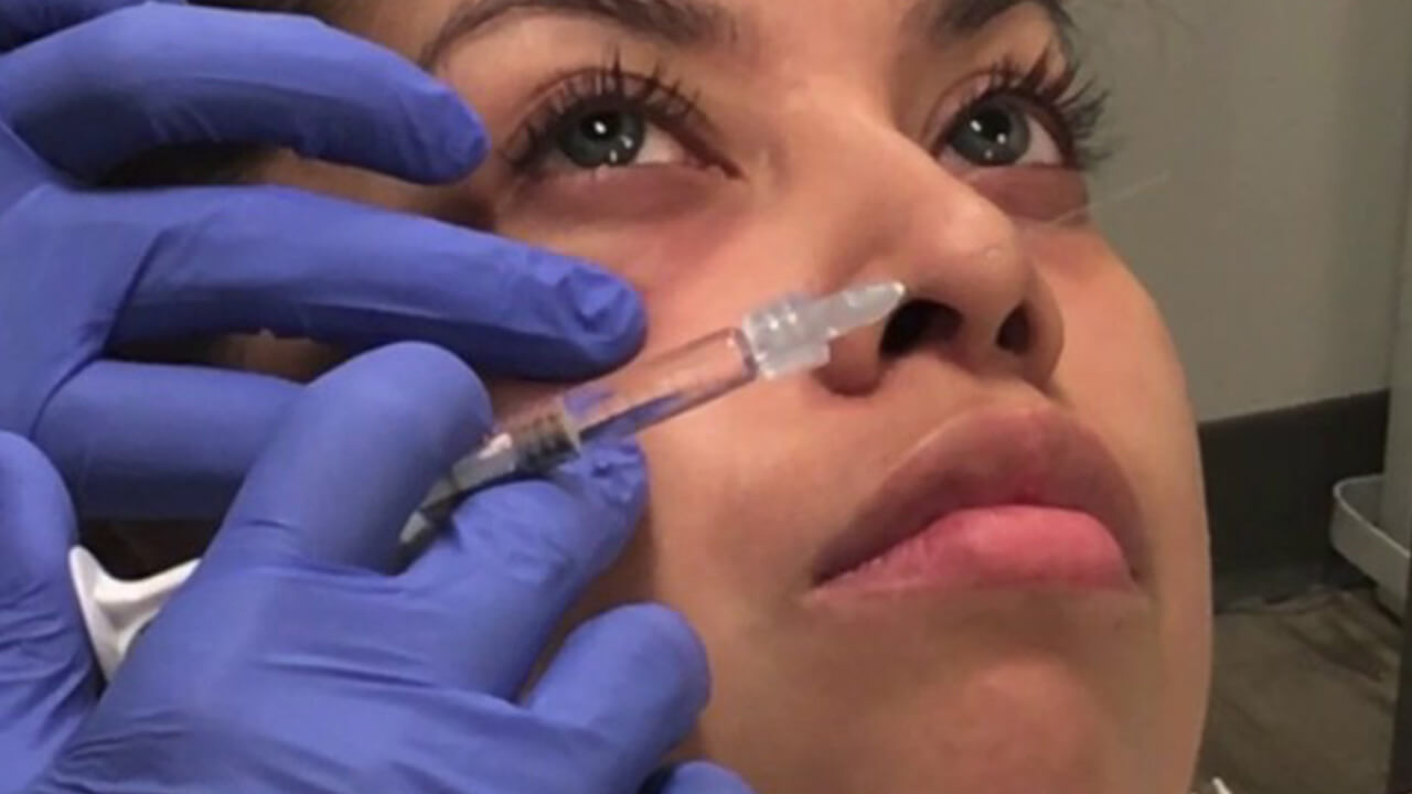 belotero injections tear trough video