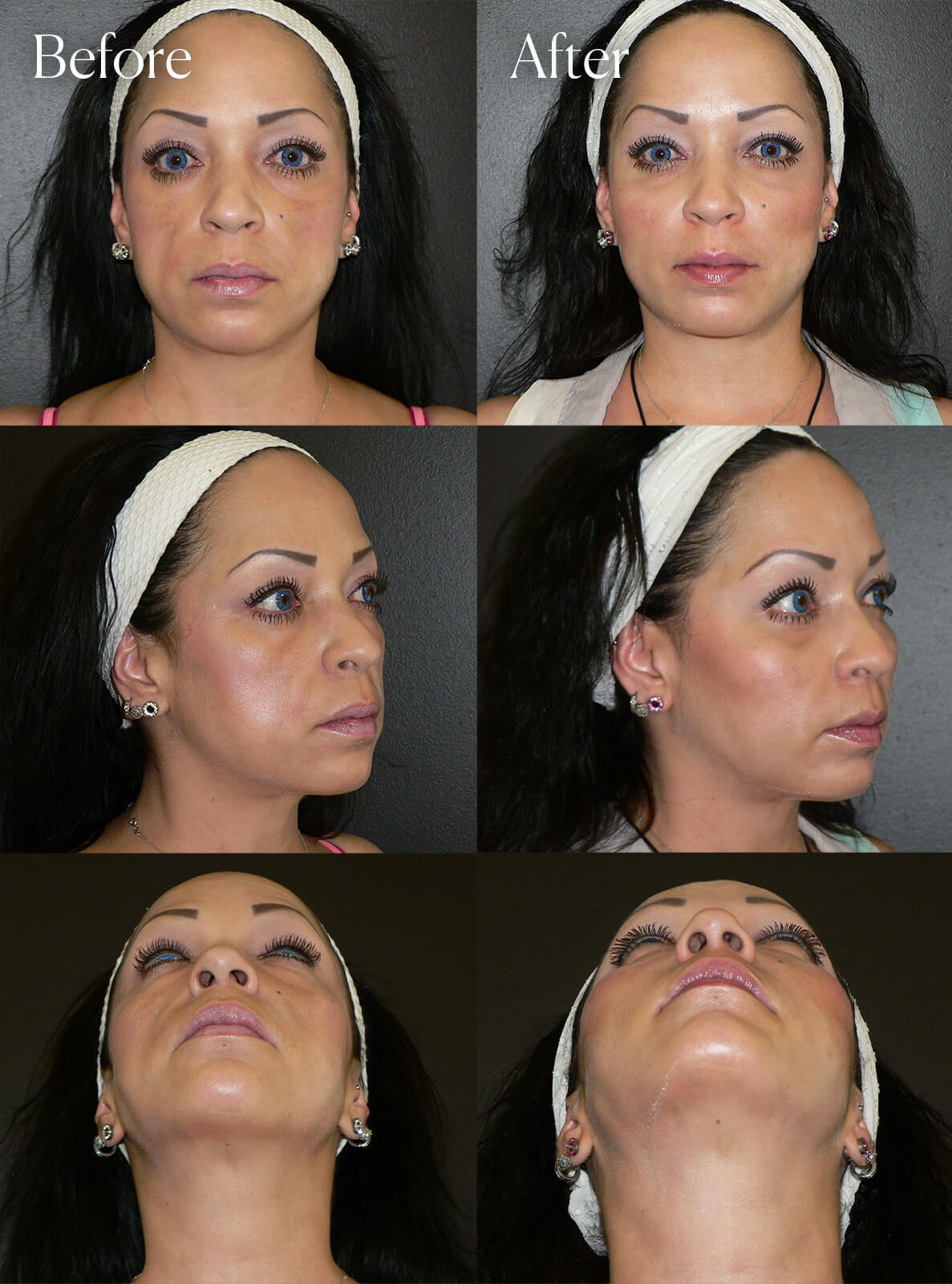 cheek implant facial procedure