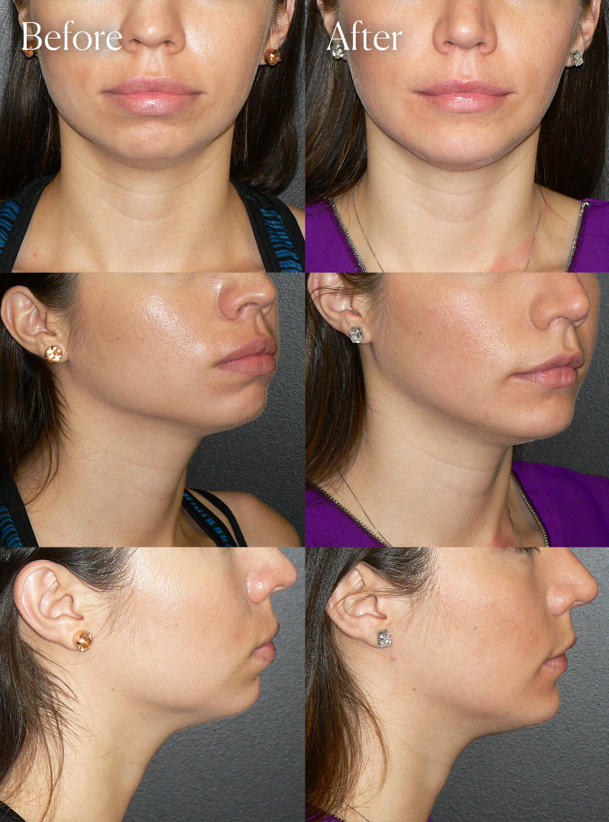 chin implant facial enhancements