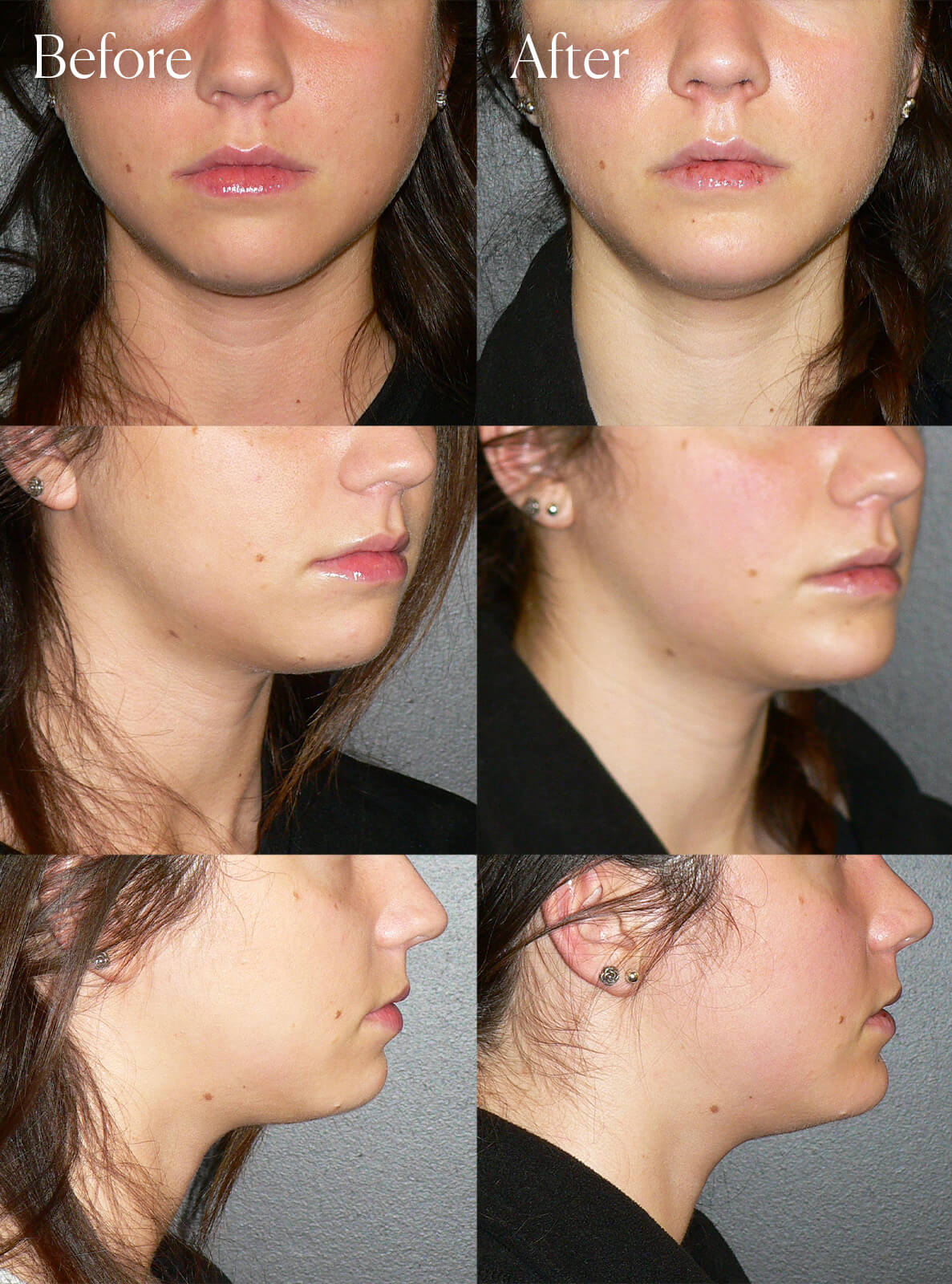 chin implant results