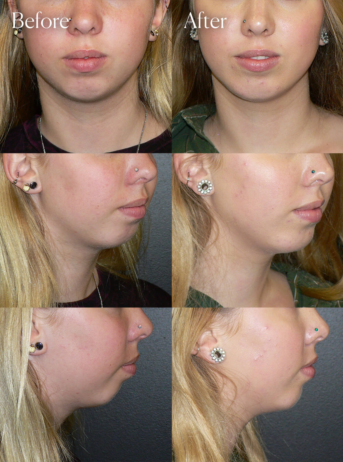 chin implant surgery colorado