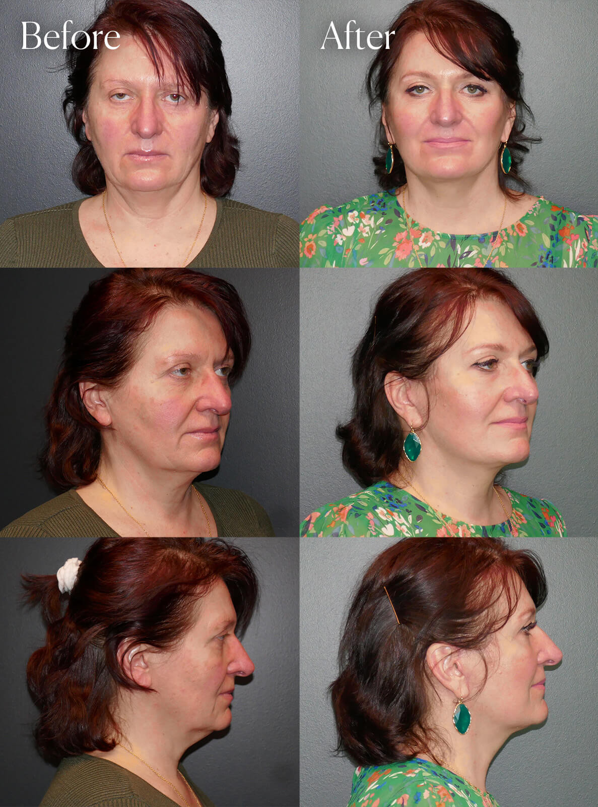 deep plane facelift necklift surgery results