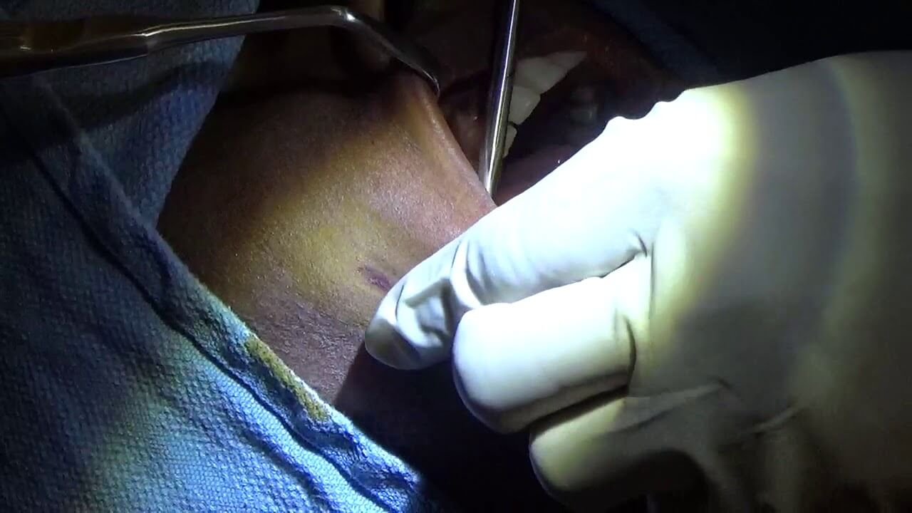 dimpleplasty surgery video