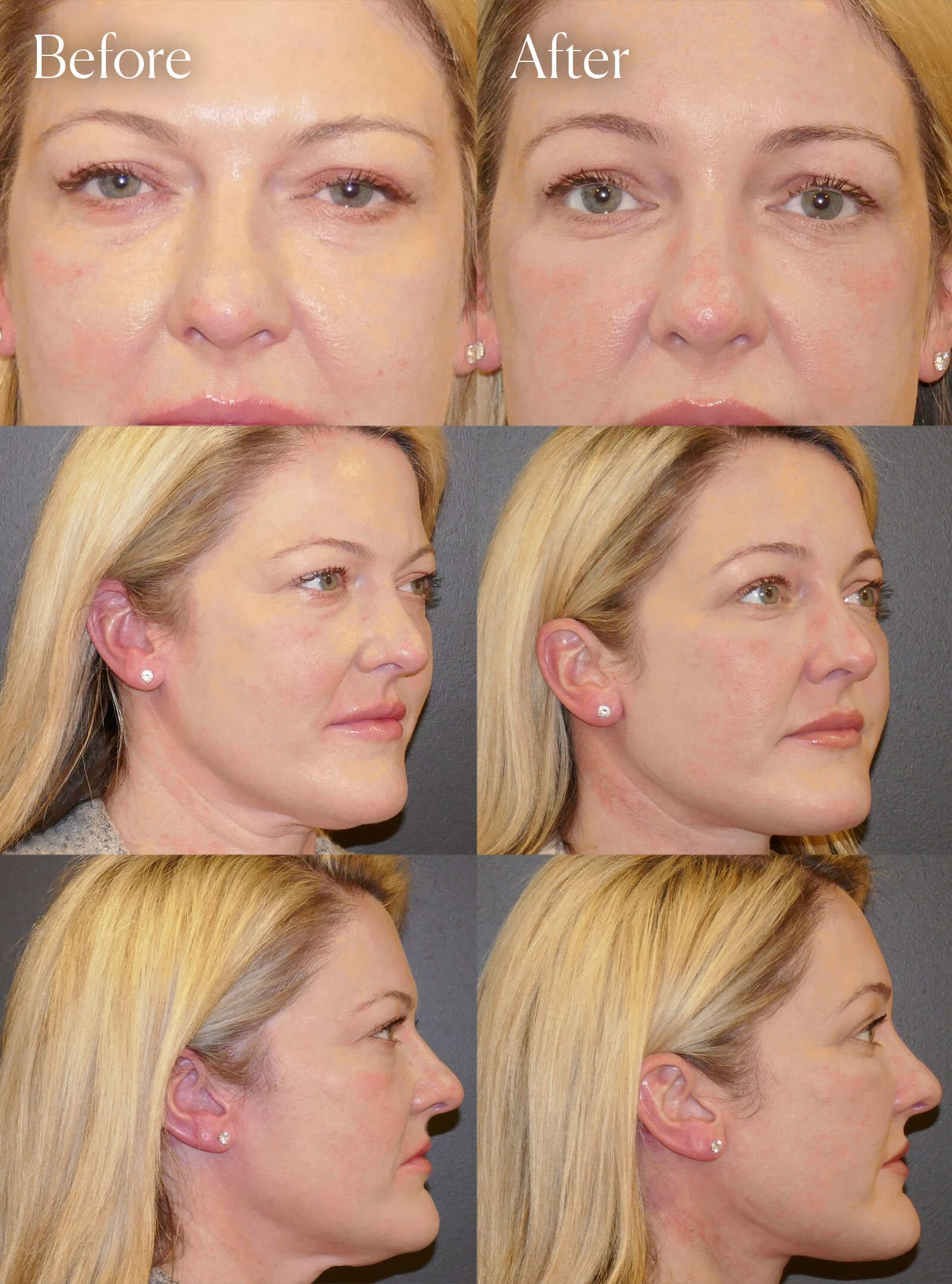 endo browlift surgery results