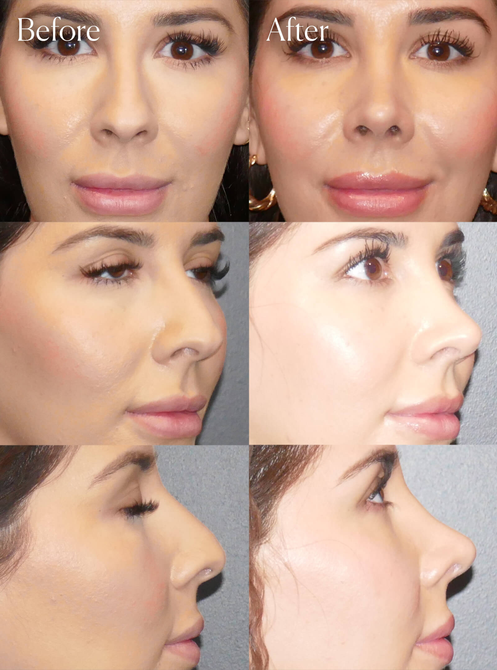 ethnic rhinoplasty before and after