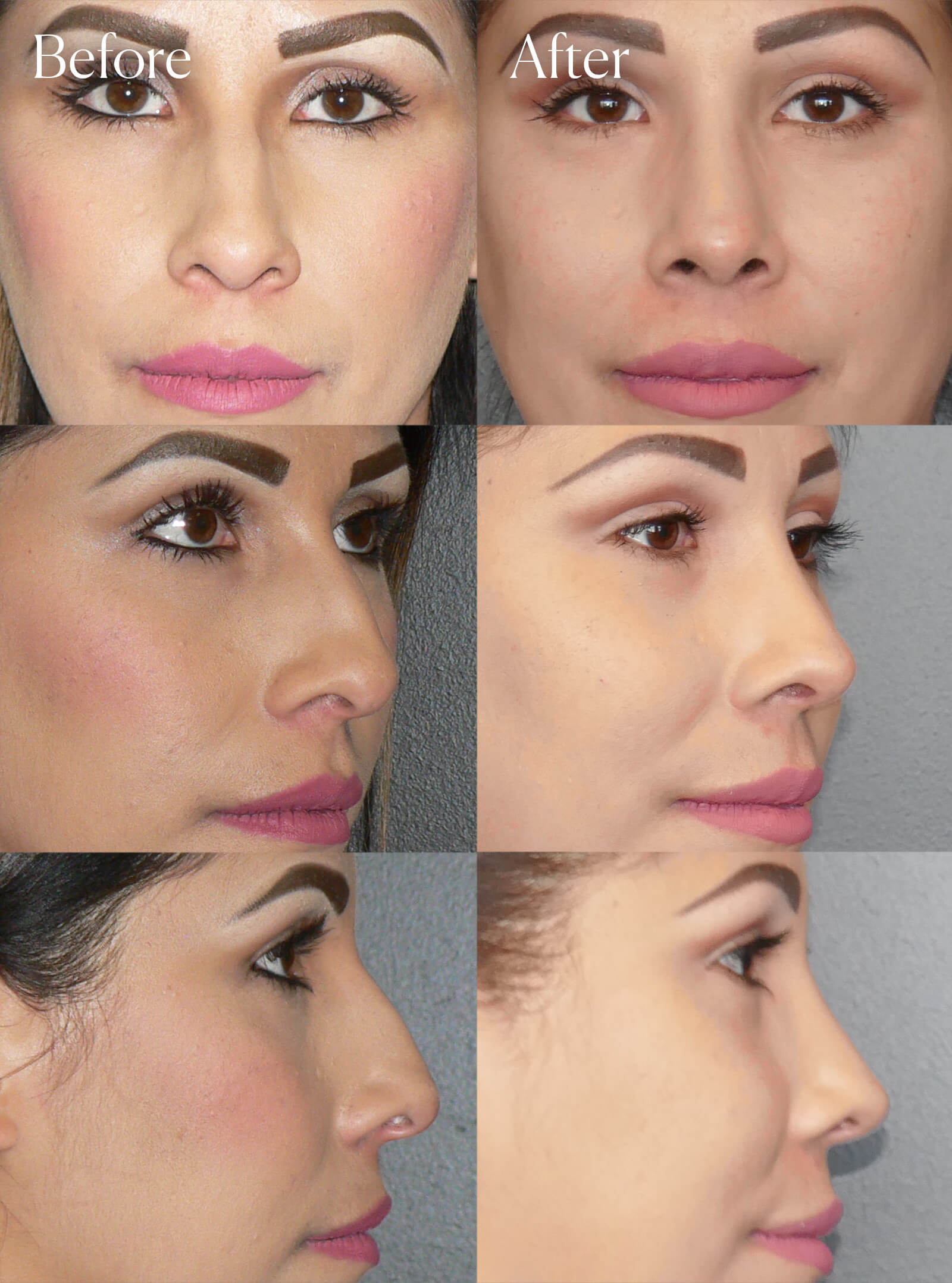 ethnic ultrasonic rhinoplasty before and after