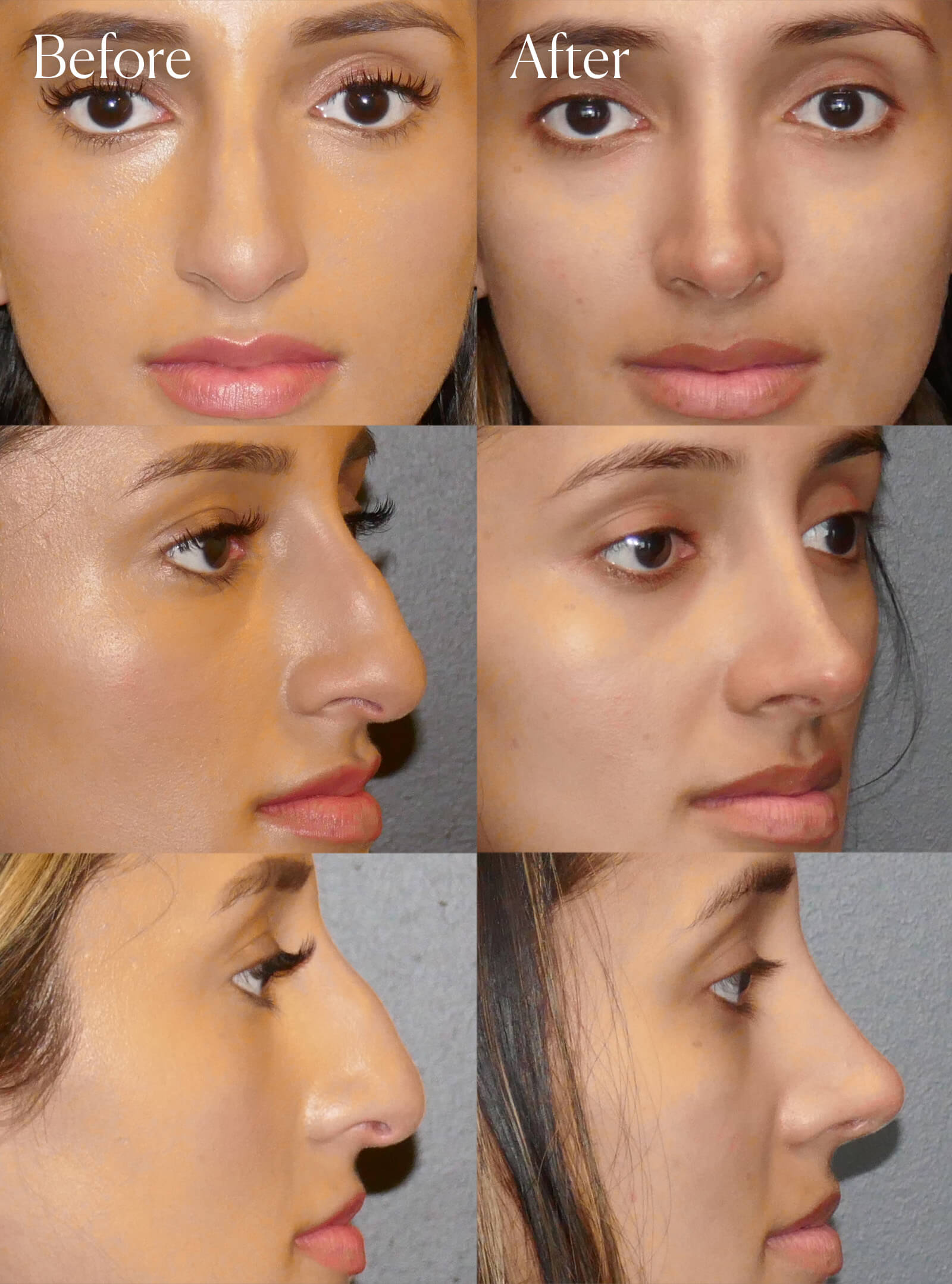 ethnic ultrasonic rhinoplasty facial enhancements