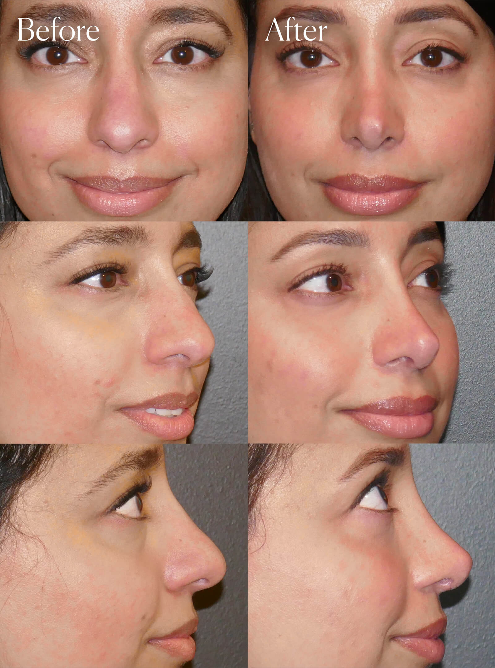 ethnic ultrasonic rhinoplasty plastic surgery