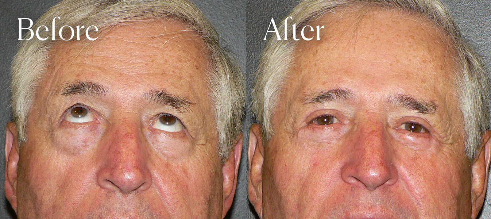 eyelid lift facial procedure