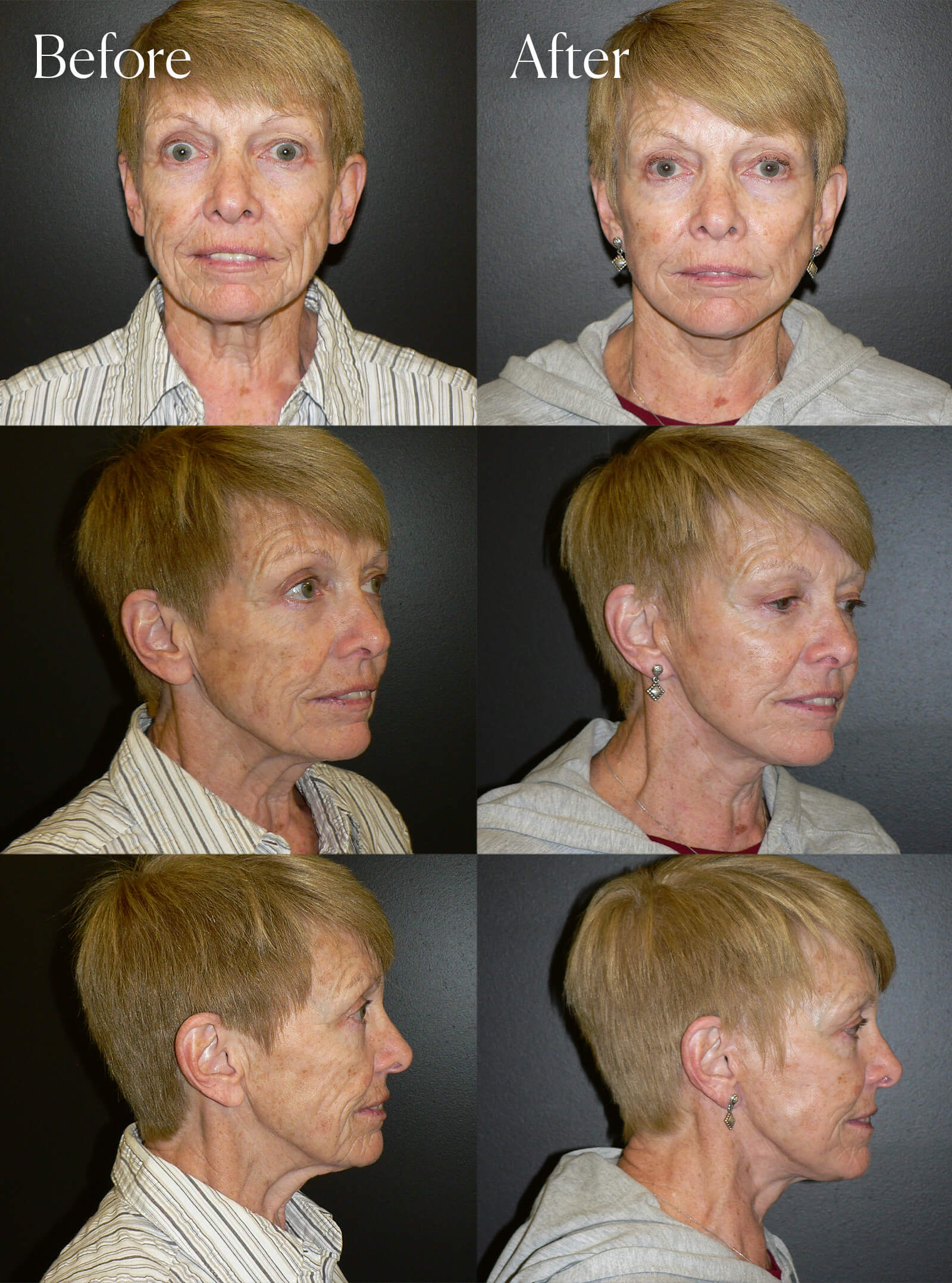 facelift before and after