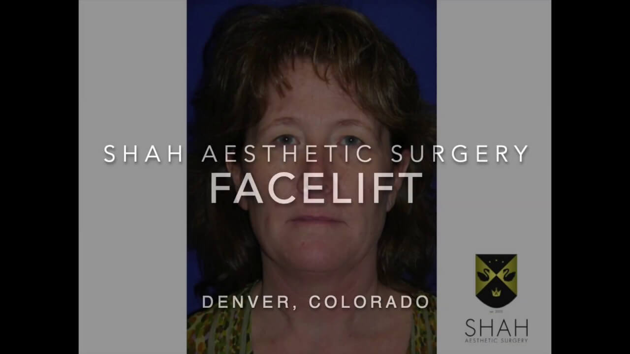 facelift natural results video