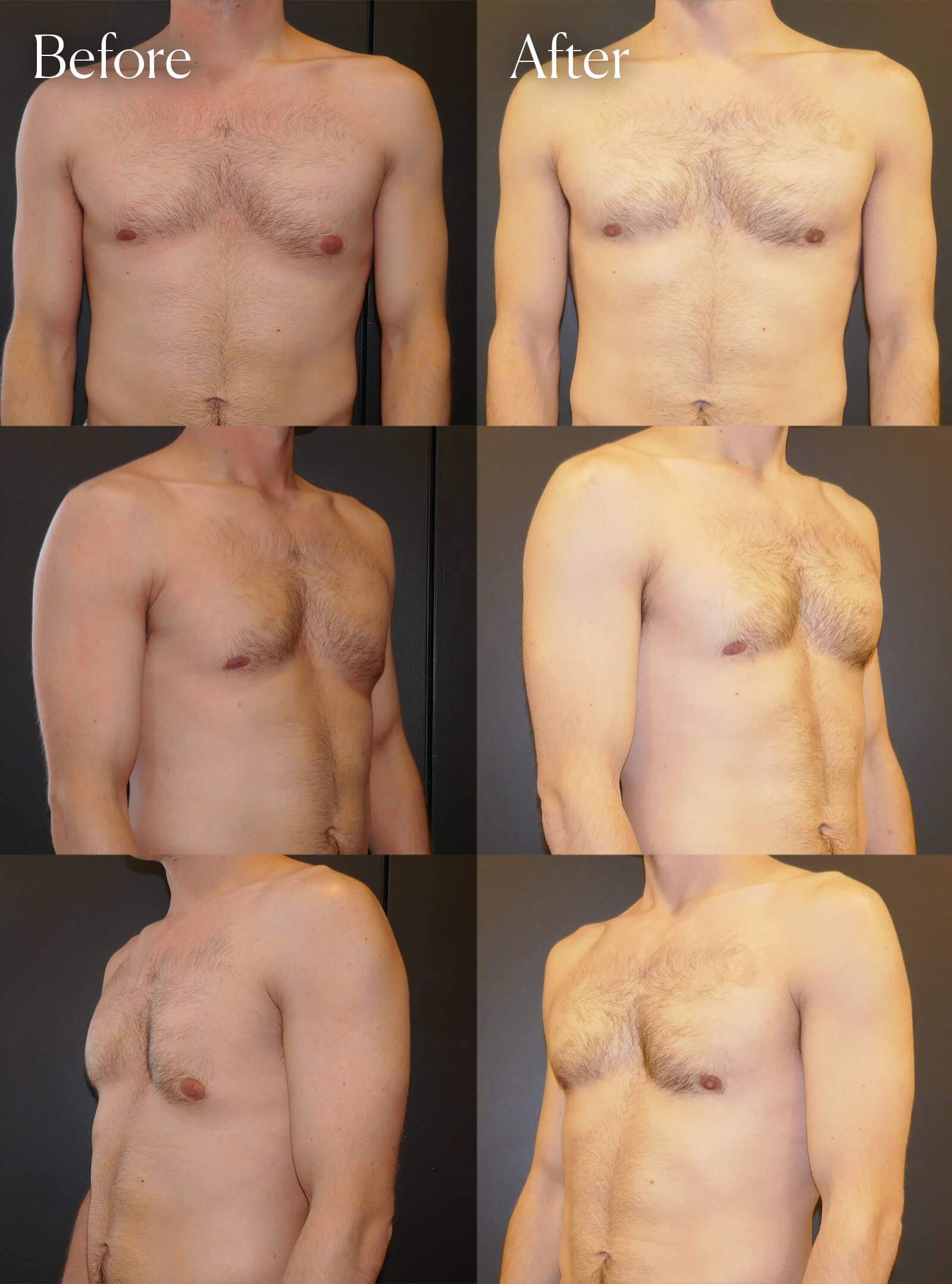 gynecomastia unilateral before and after