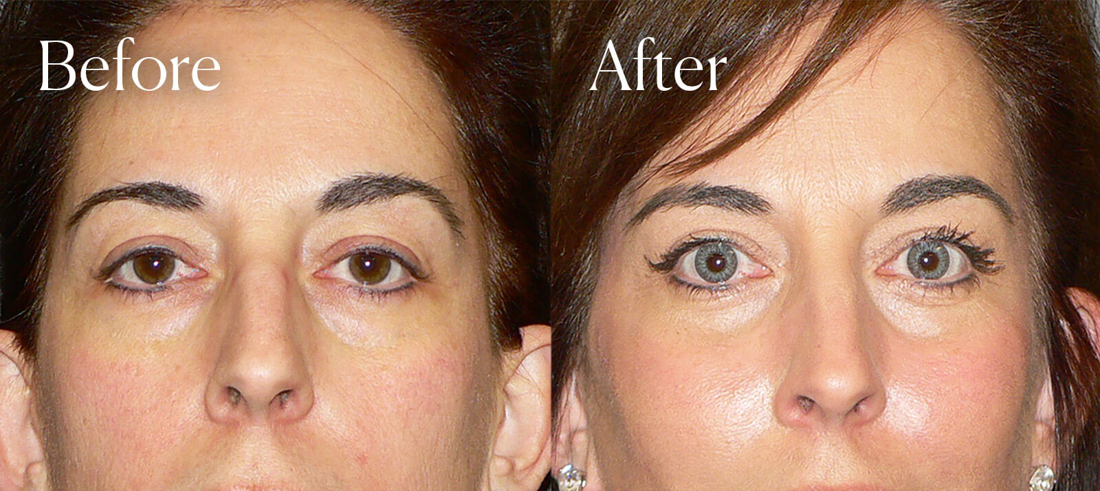 lower blepharoplasty facial enhancements