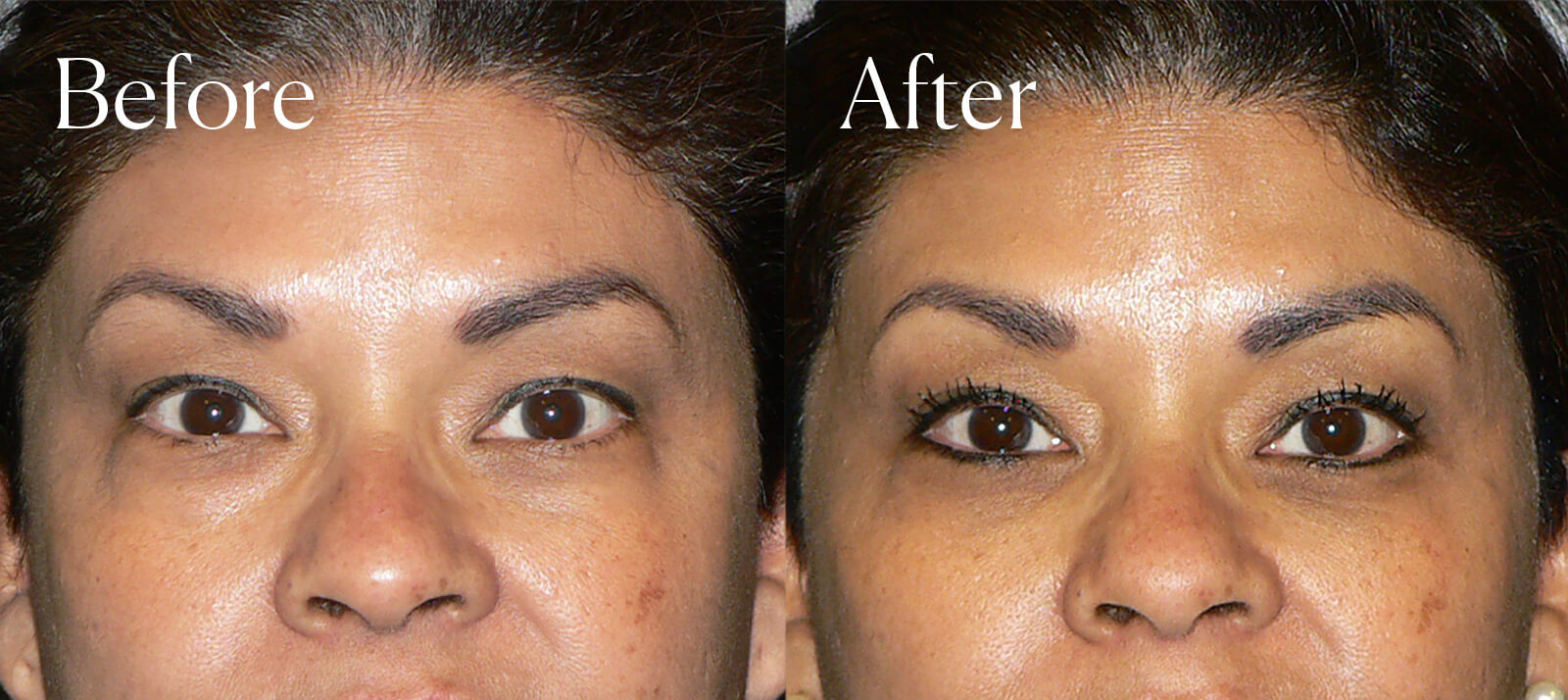 lower eyelid lift facial procedure