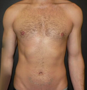 male breast reduction after