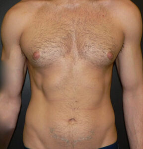 male breast reduction before