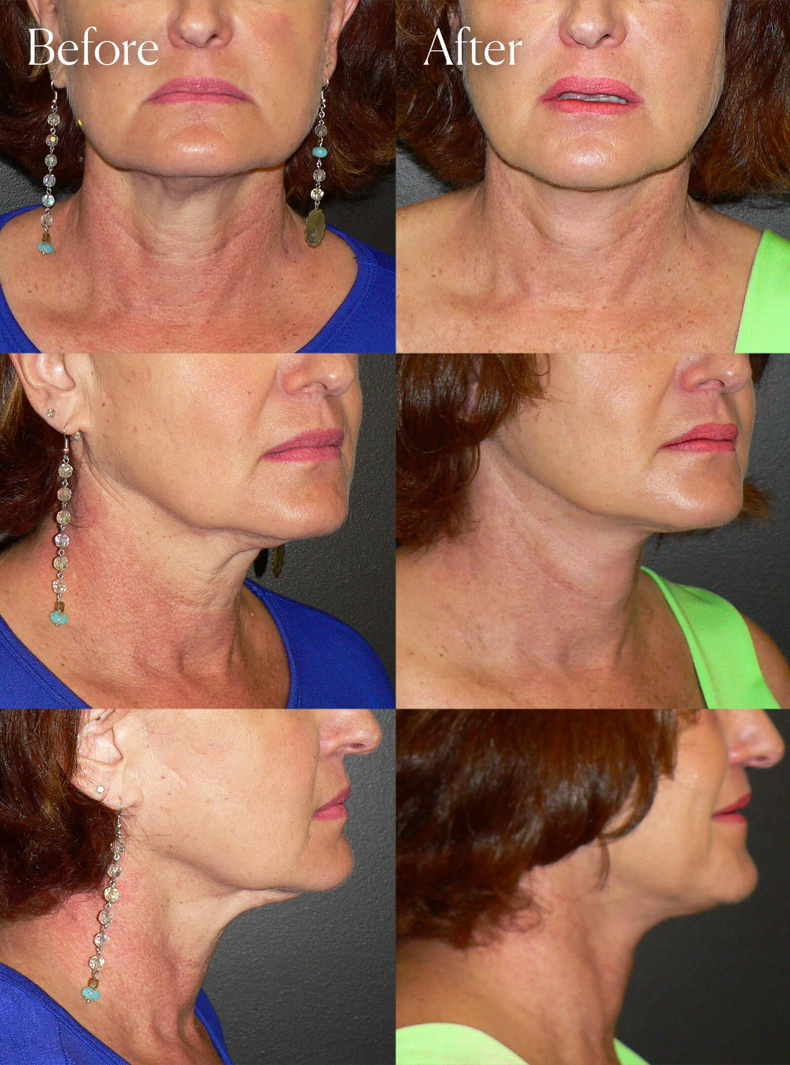 necklift before and after