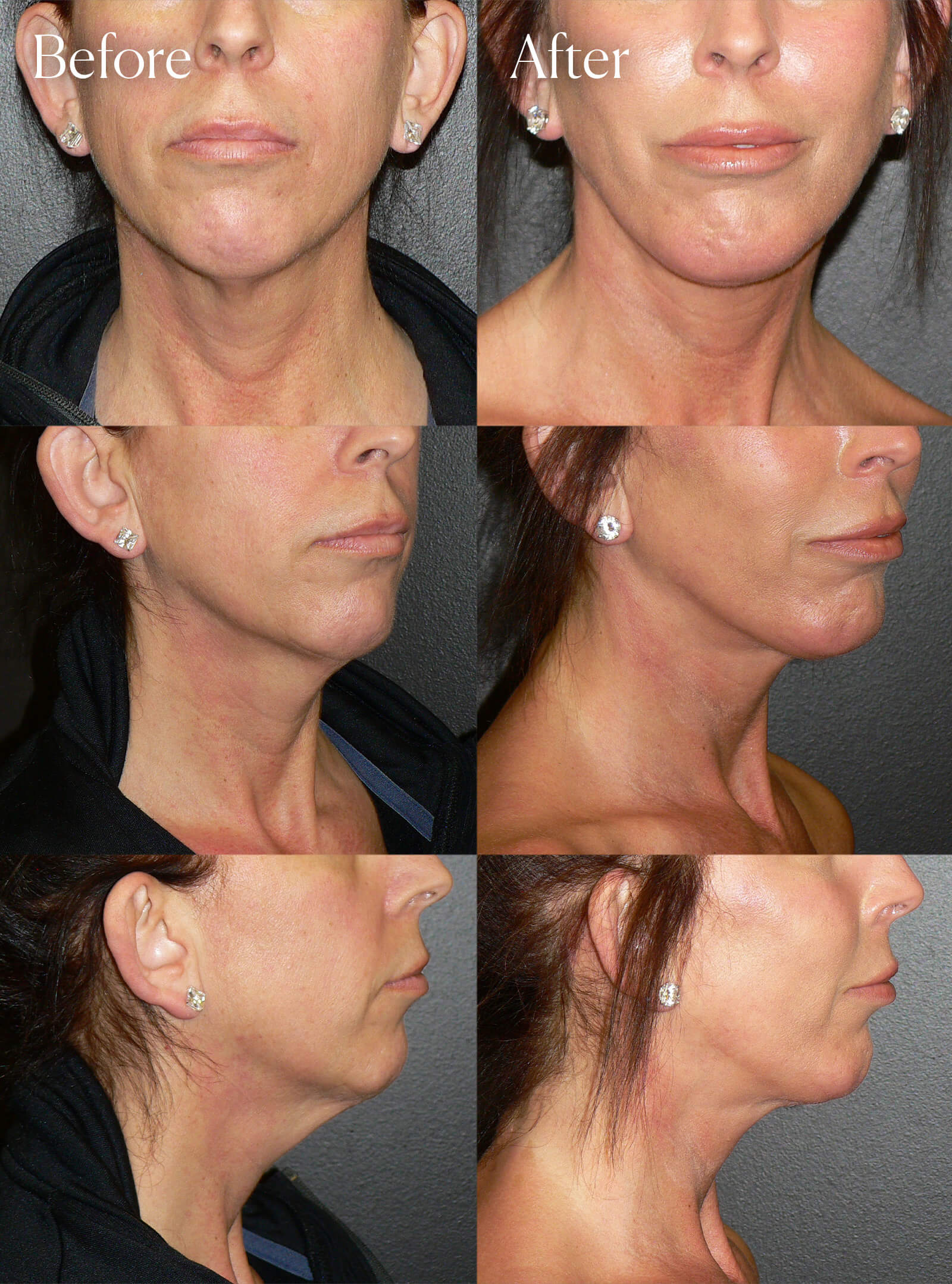 necklift facial enhancements