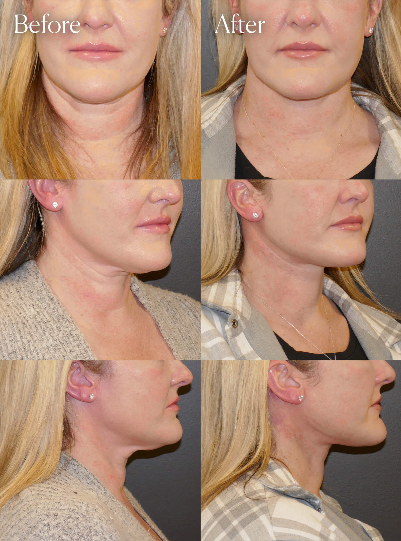 necklift facial procedure