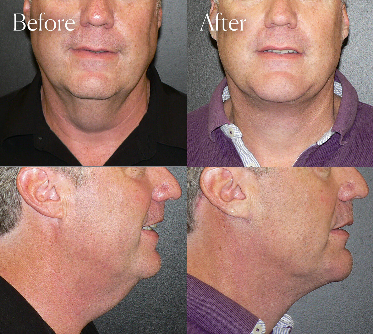 necklift surgery results