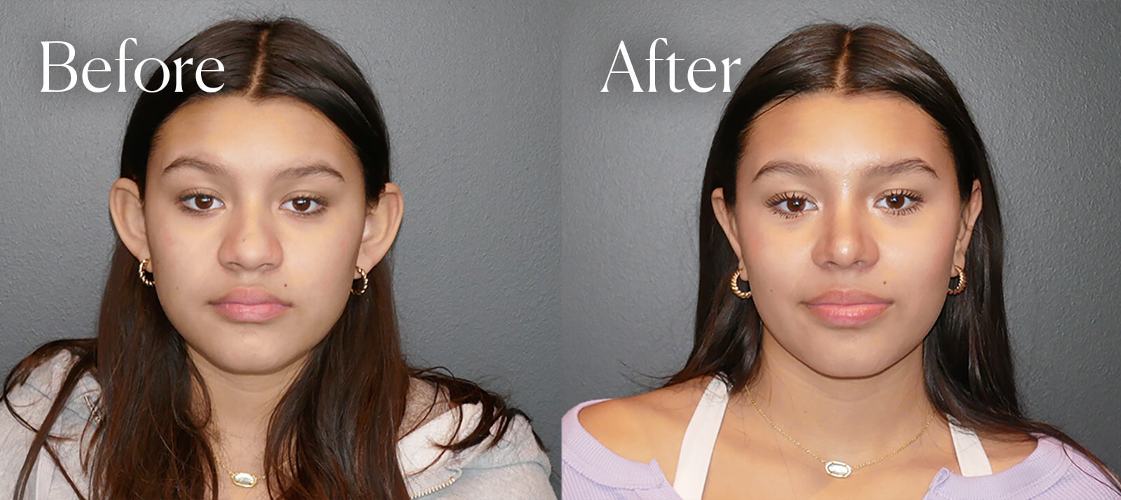 otoplasty before and after