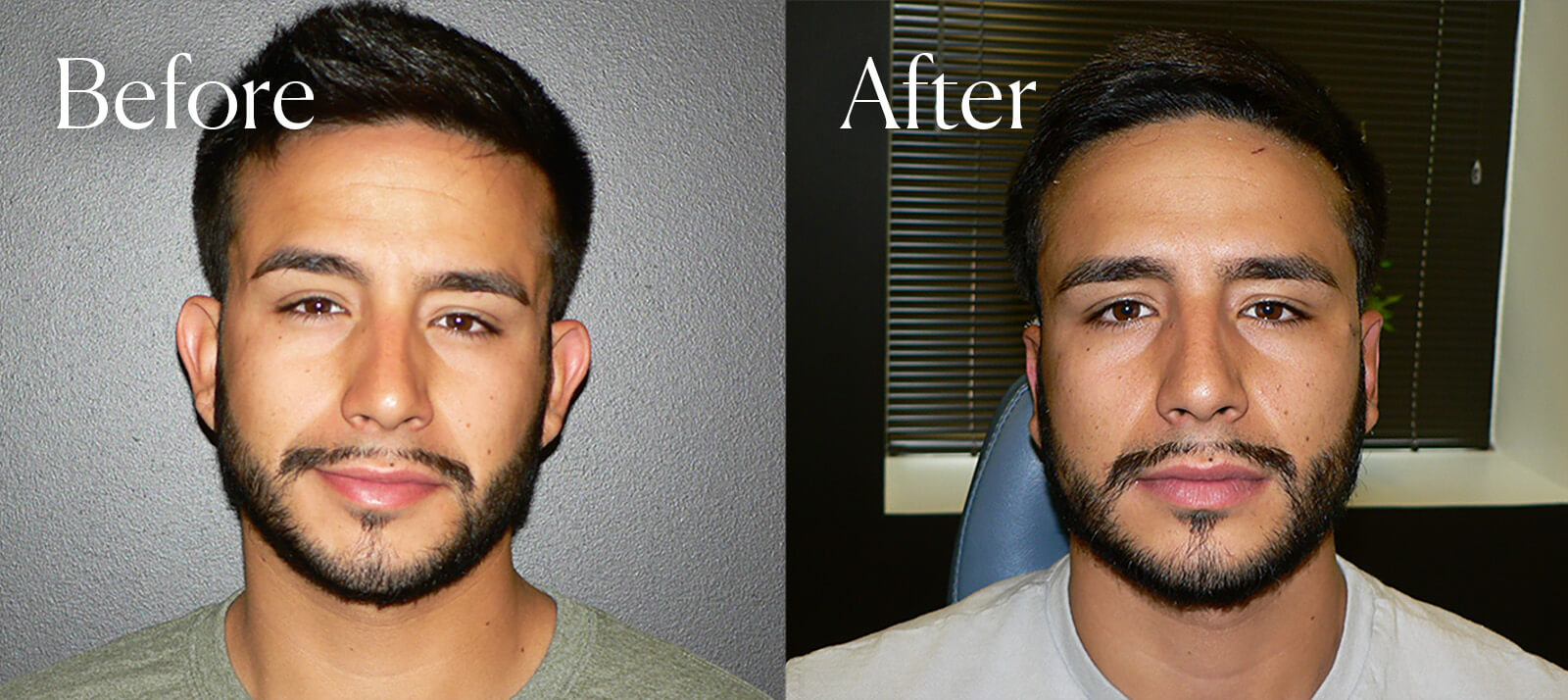 otoplasty surgery results
