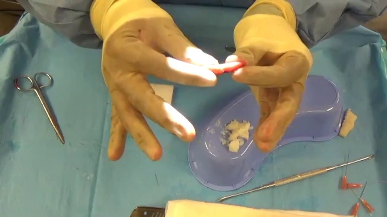 plastic surgery graft hack video