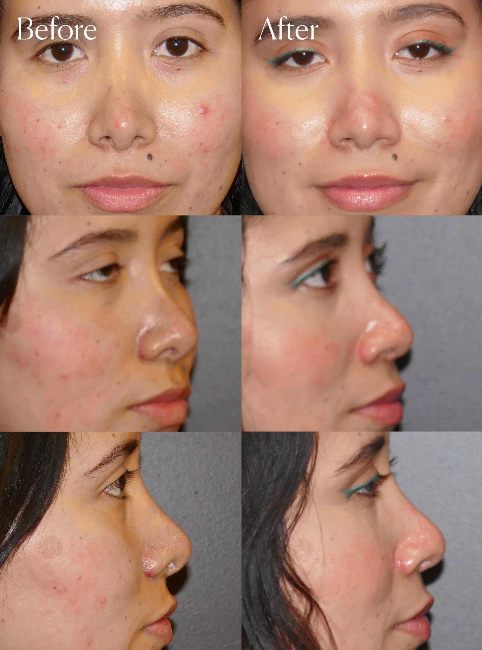 revision ethnic rhinoplasty facial enhancements