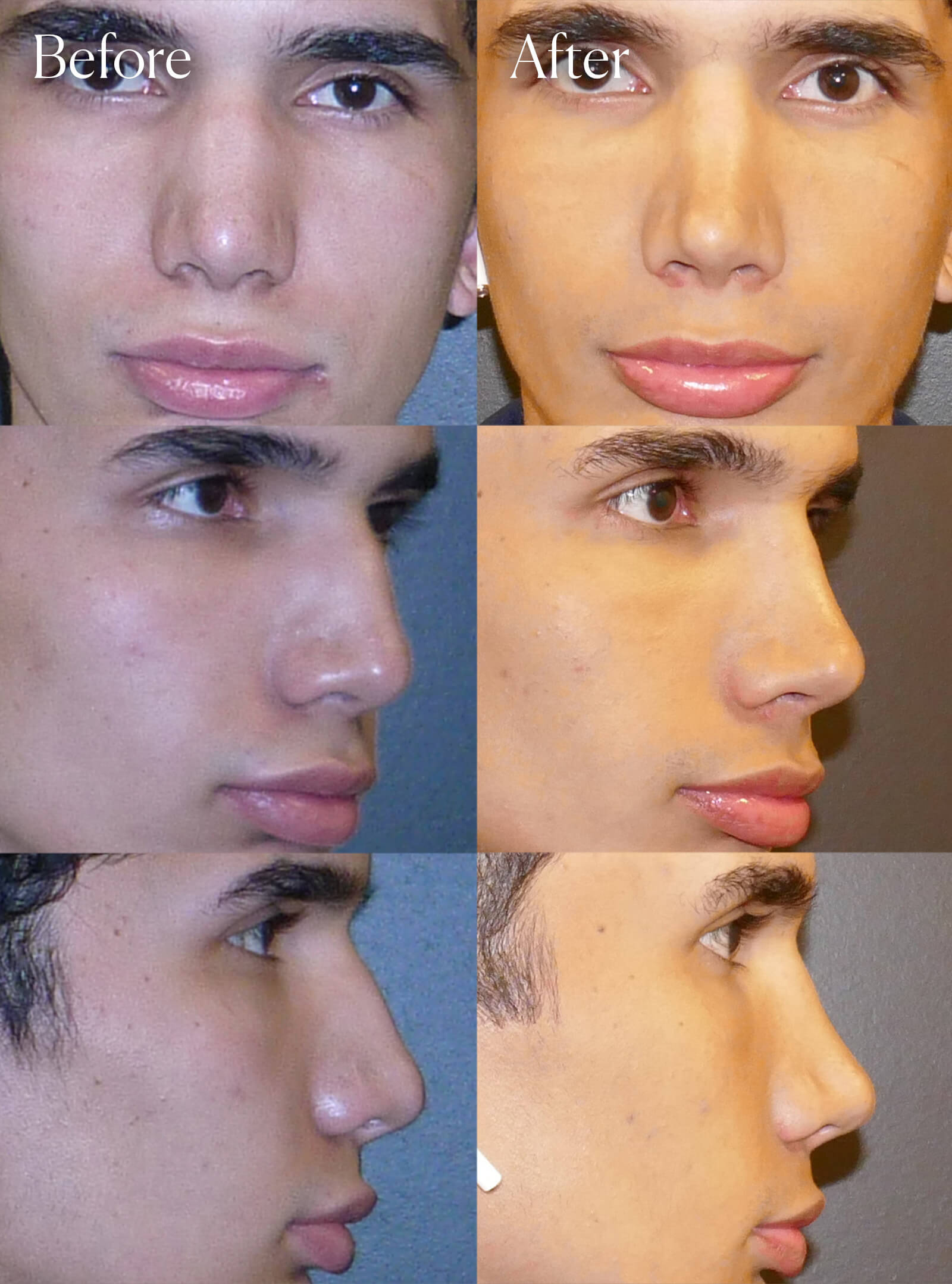revision ethnic rhinoplasty surgery results