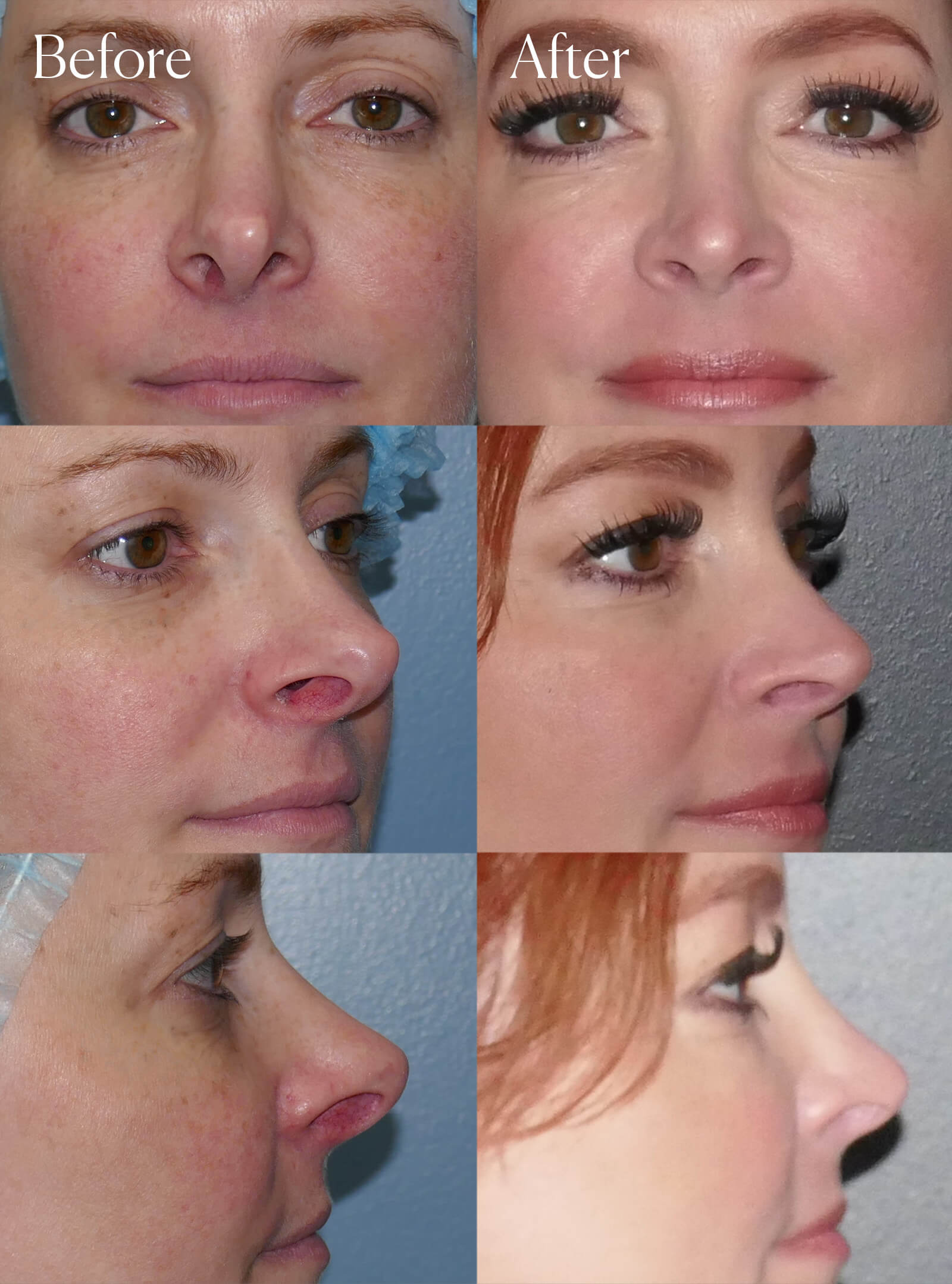revision rhinoplasty facial enhancements