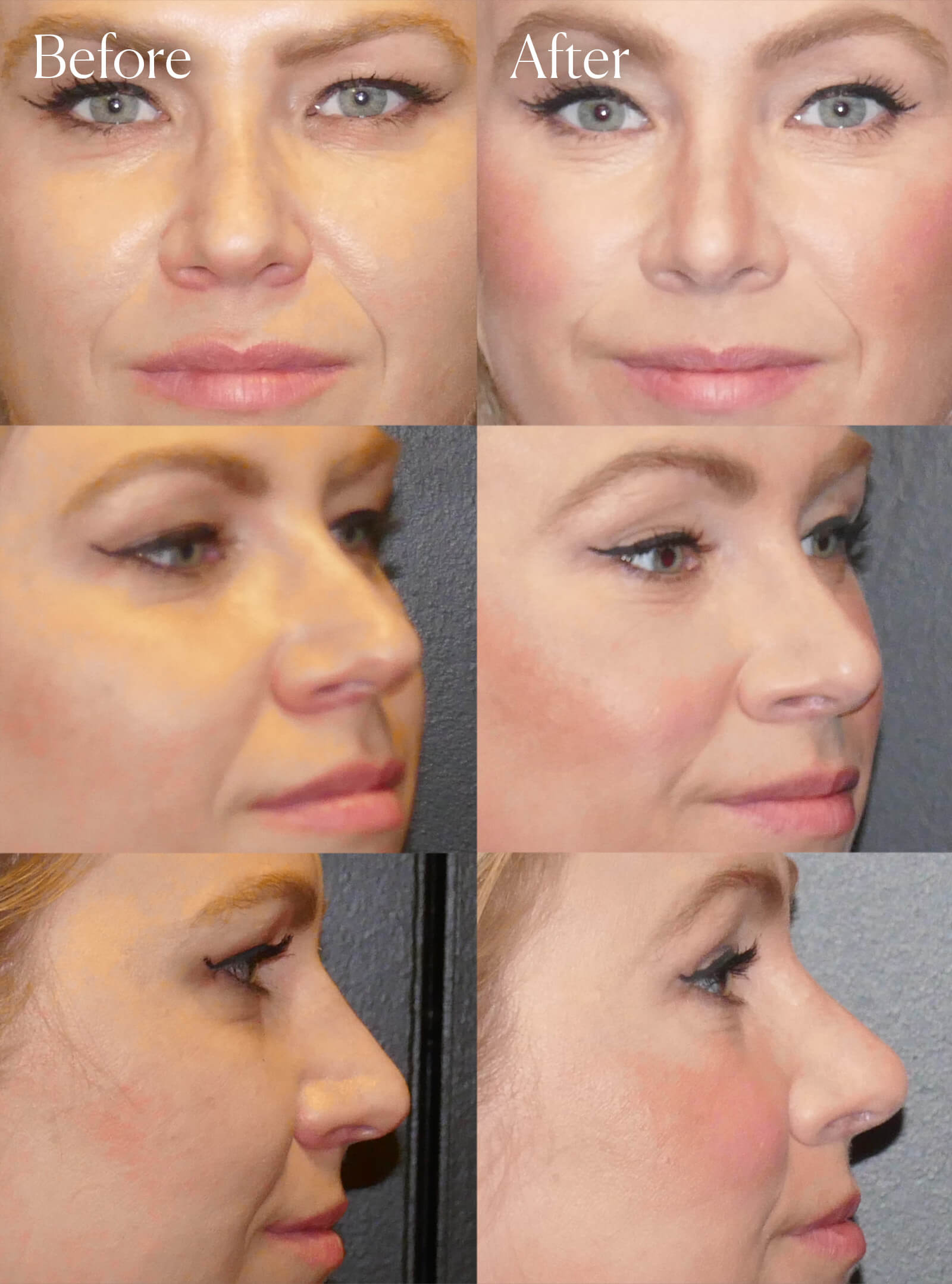 revision rhinoplasty surgery results