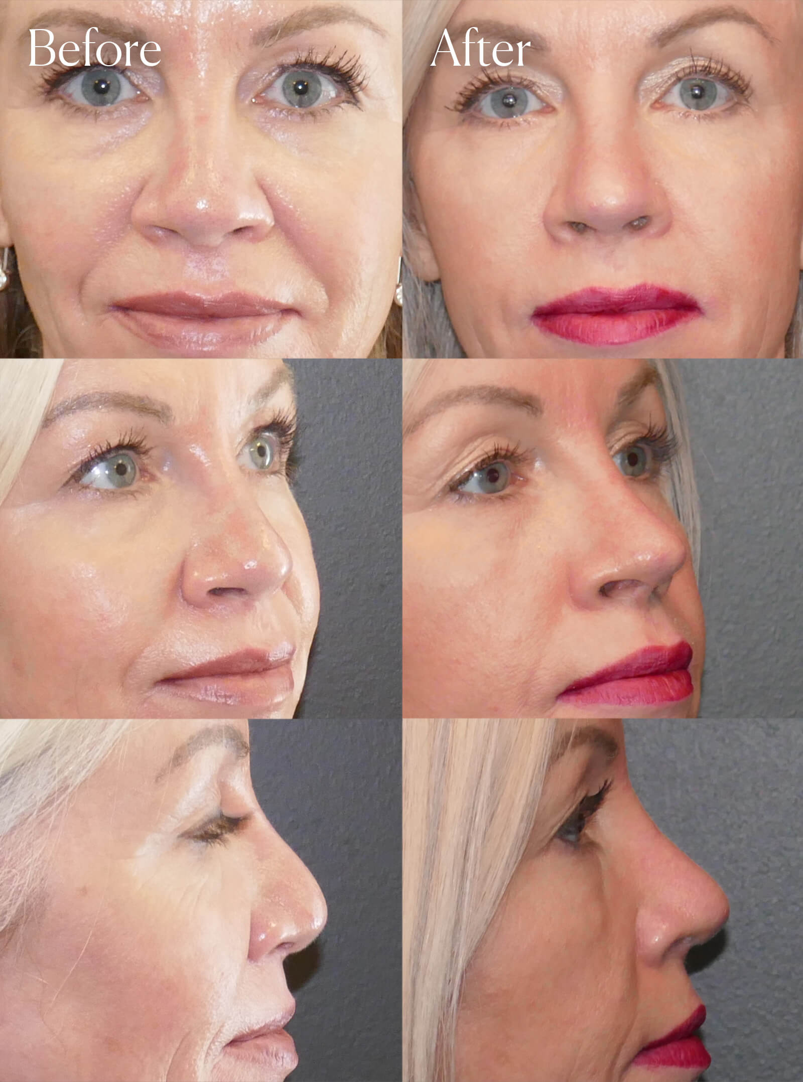 revision ultrasonic rhinoplasty surgery results