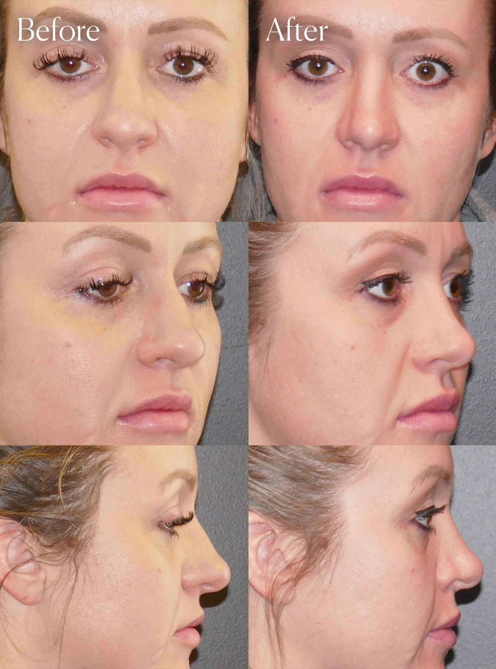 rhinoplasty facial enhancements