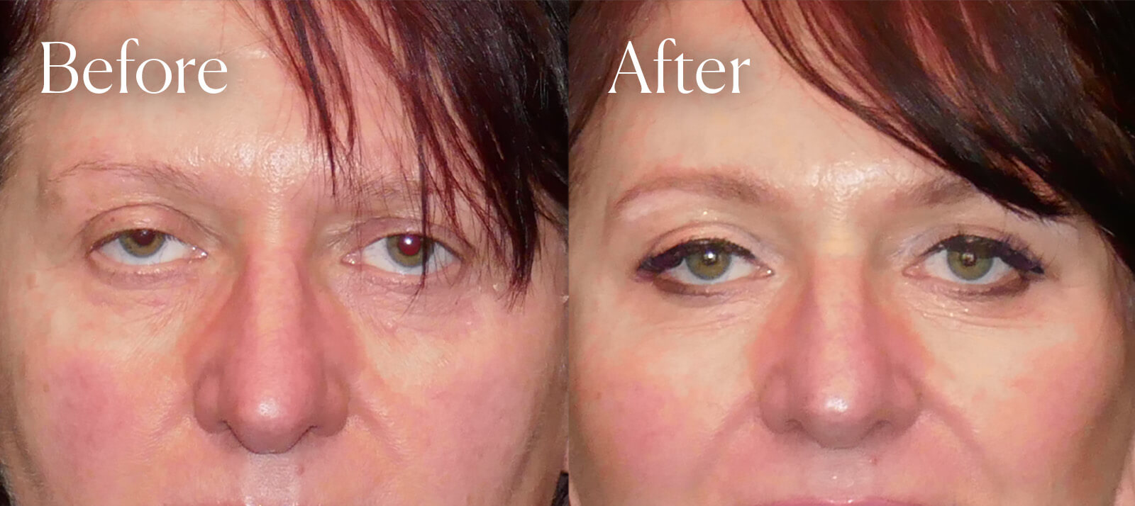 temporal browlift before and after