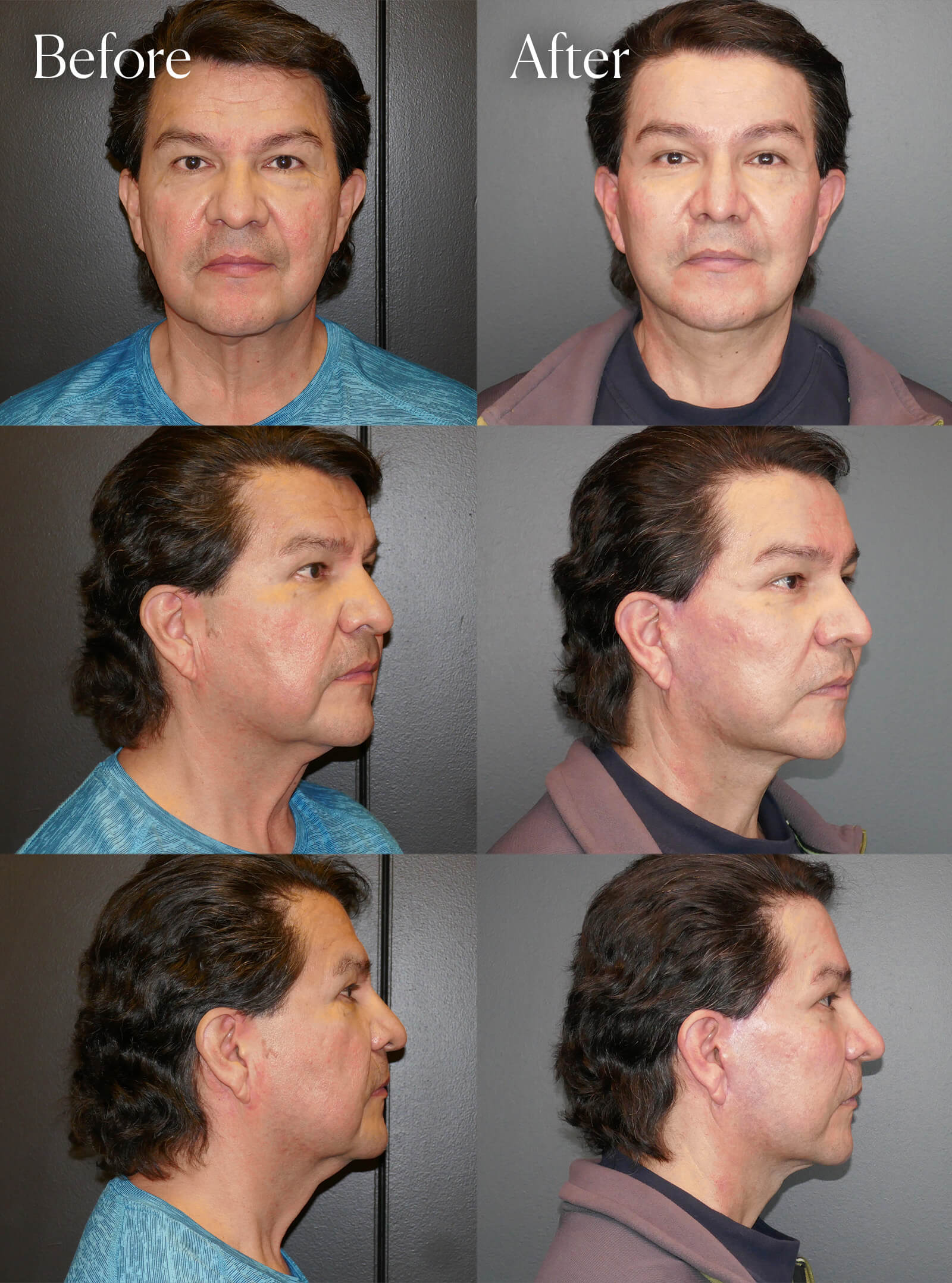 ultralift facelift necklift before and after