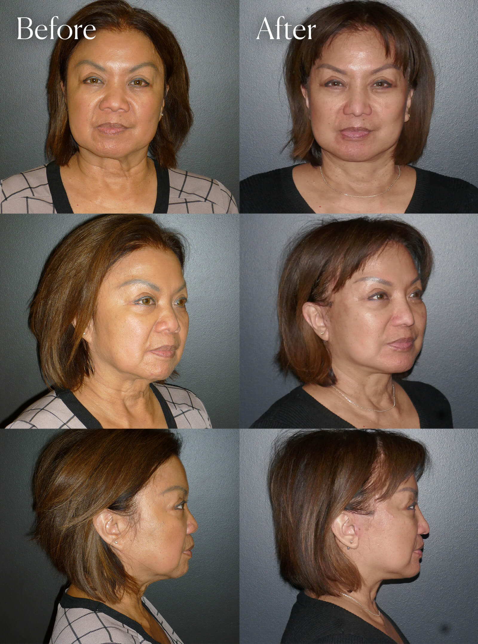 ultralift facelift necklift chin implant rhinoplasty
