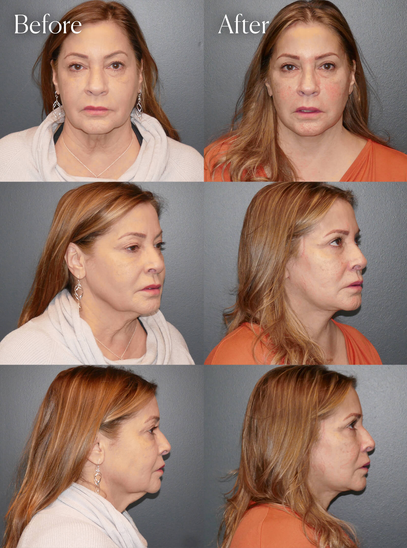 ultralift facelift surgery results