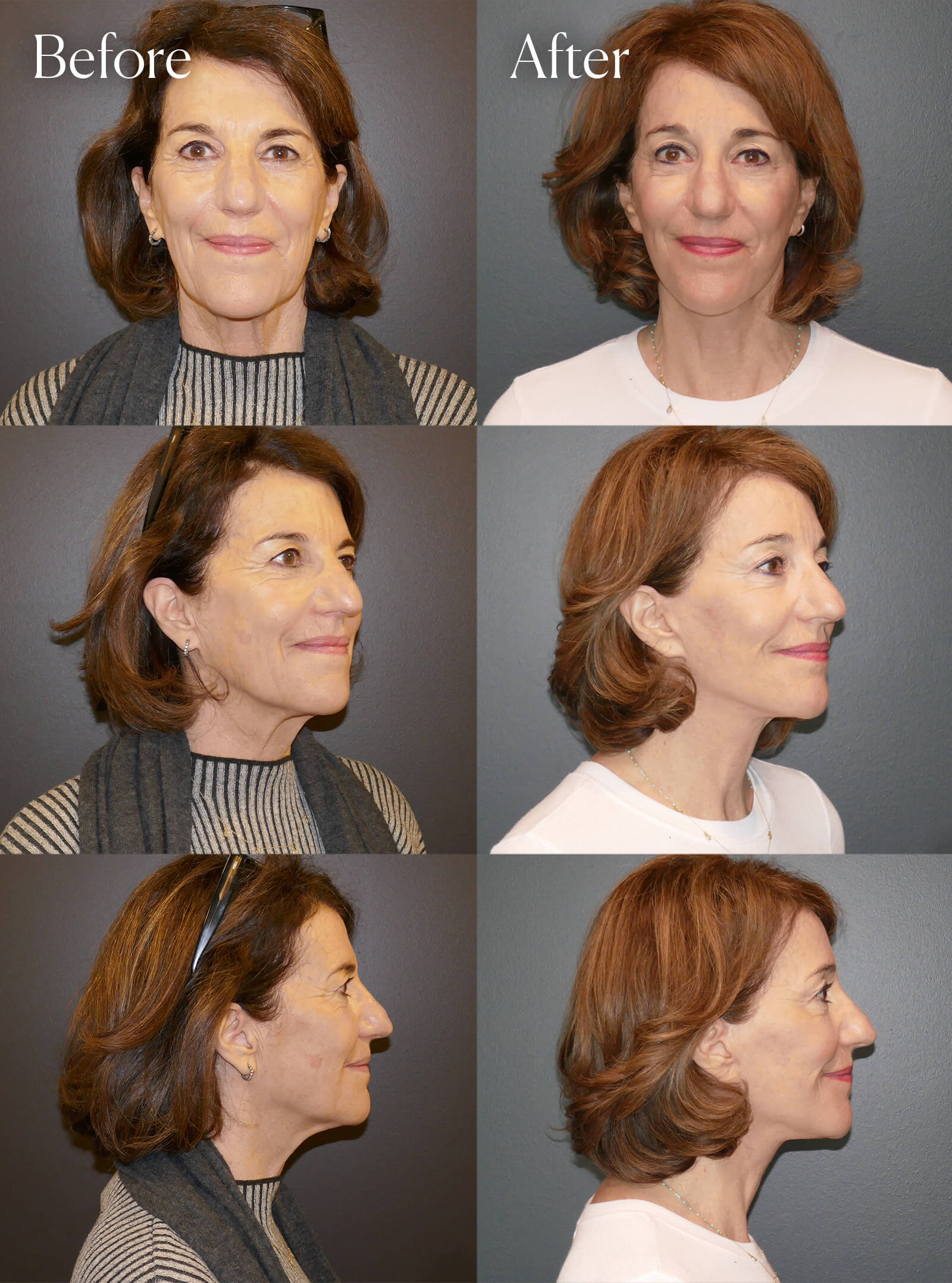 ultralift facial procedure