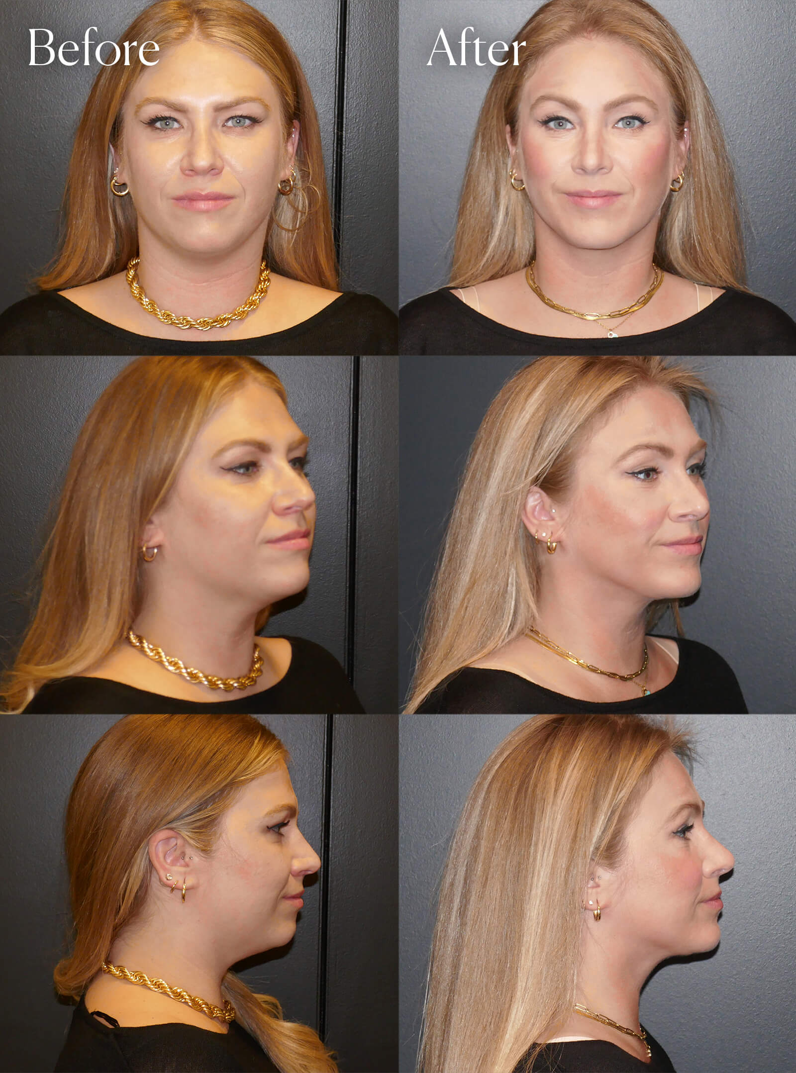 ultralift necklift chin implant browlift rhinoplasty
