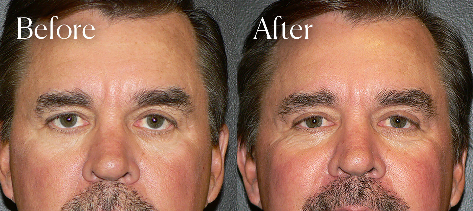 upper eyelift facial enhancements