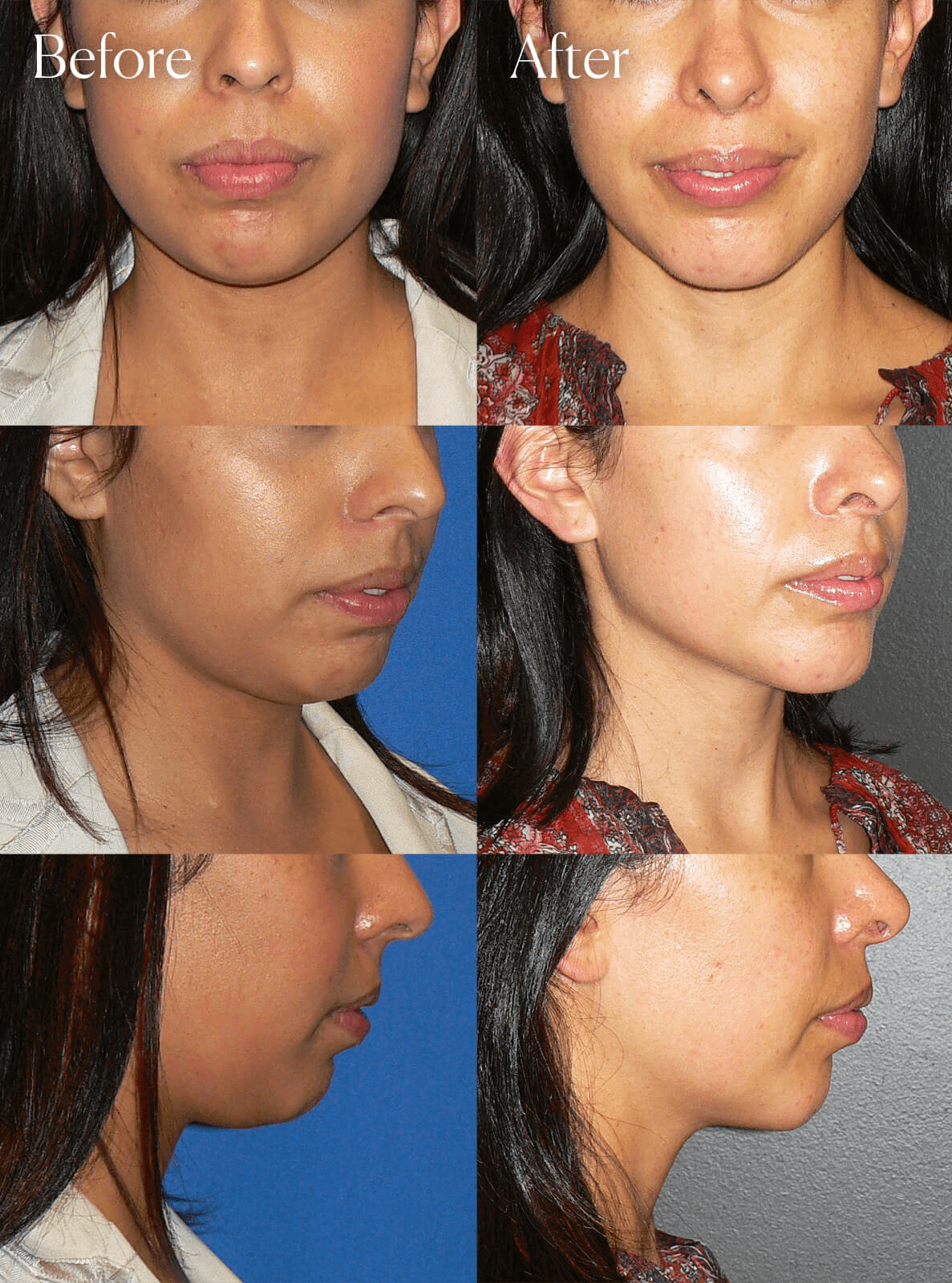 chin implant before and after