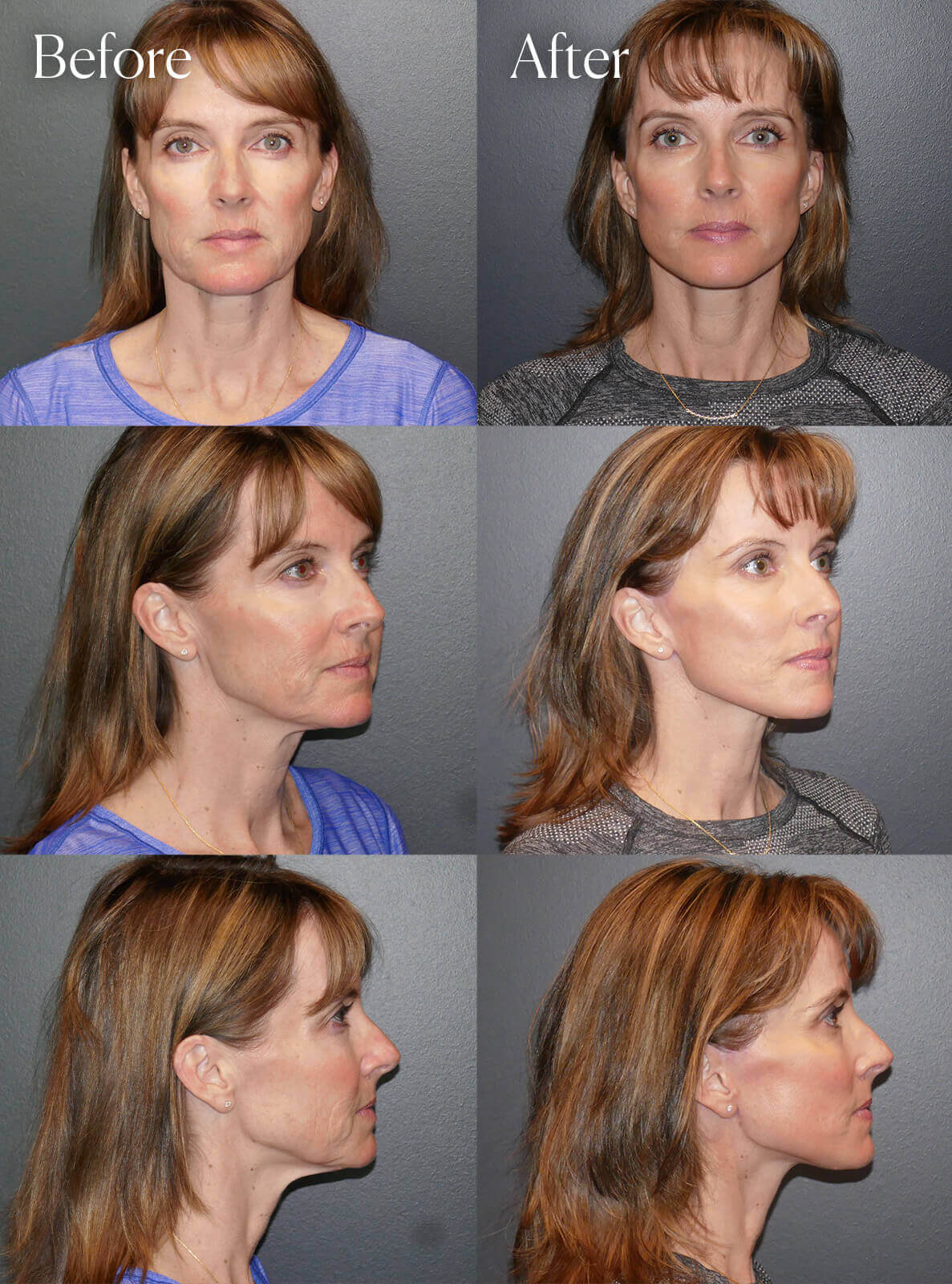 deep plane facelift necklift perfect peel