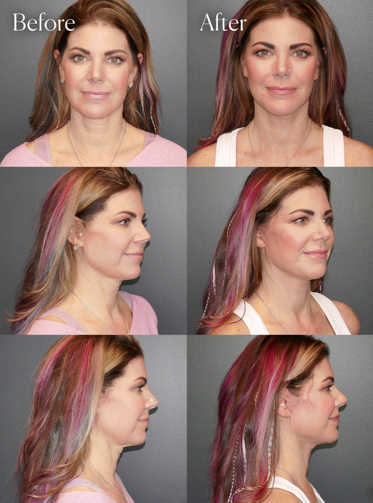 deep plane facelift plastic surgery