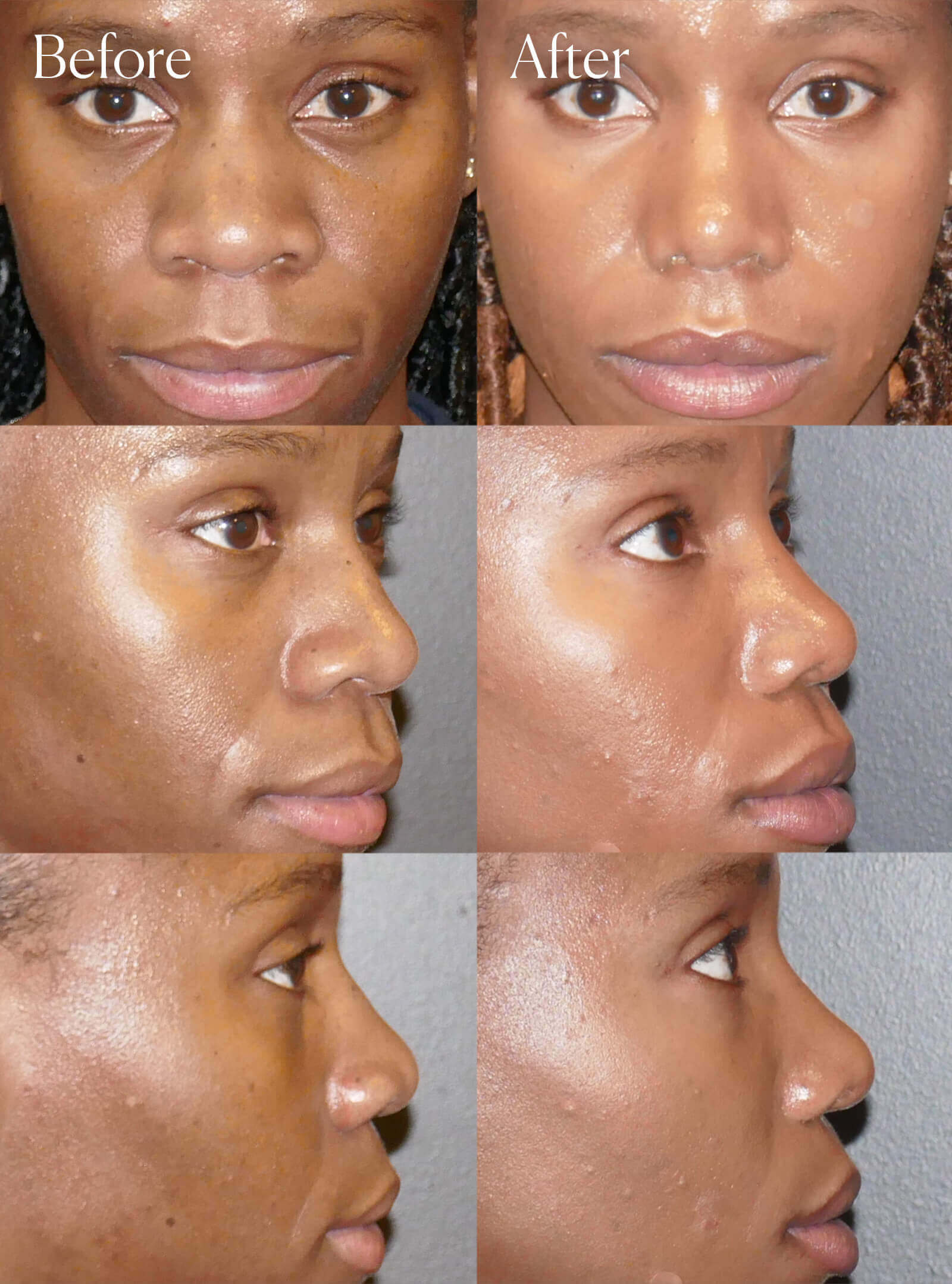 ethnic ultrasonic rhinoplasty aesthetic surgery