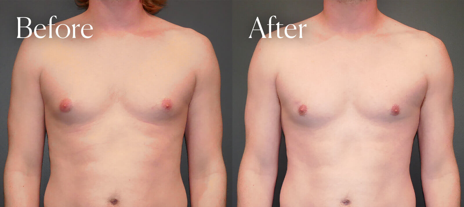 gynecomastia bilateral surgery