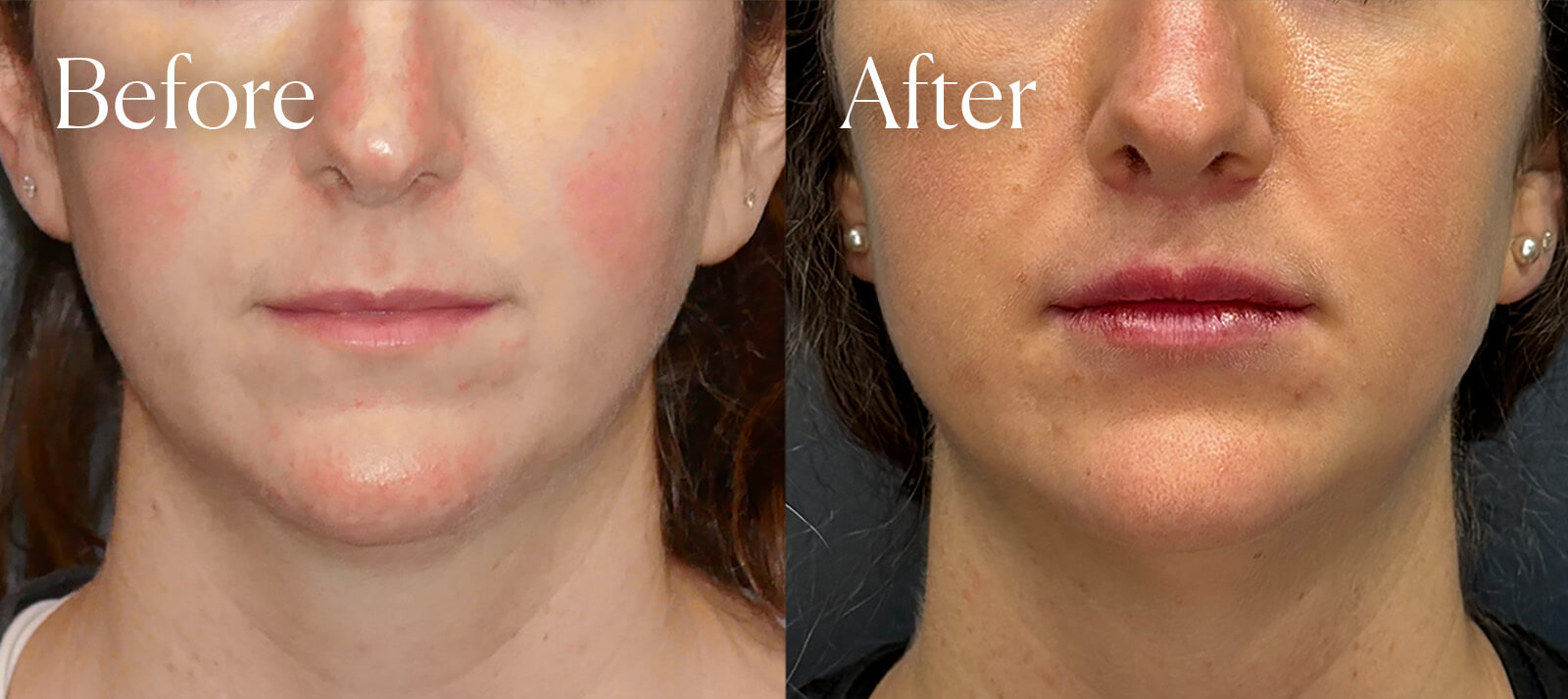 liplift aesthetic surgery