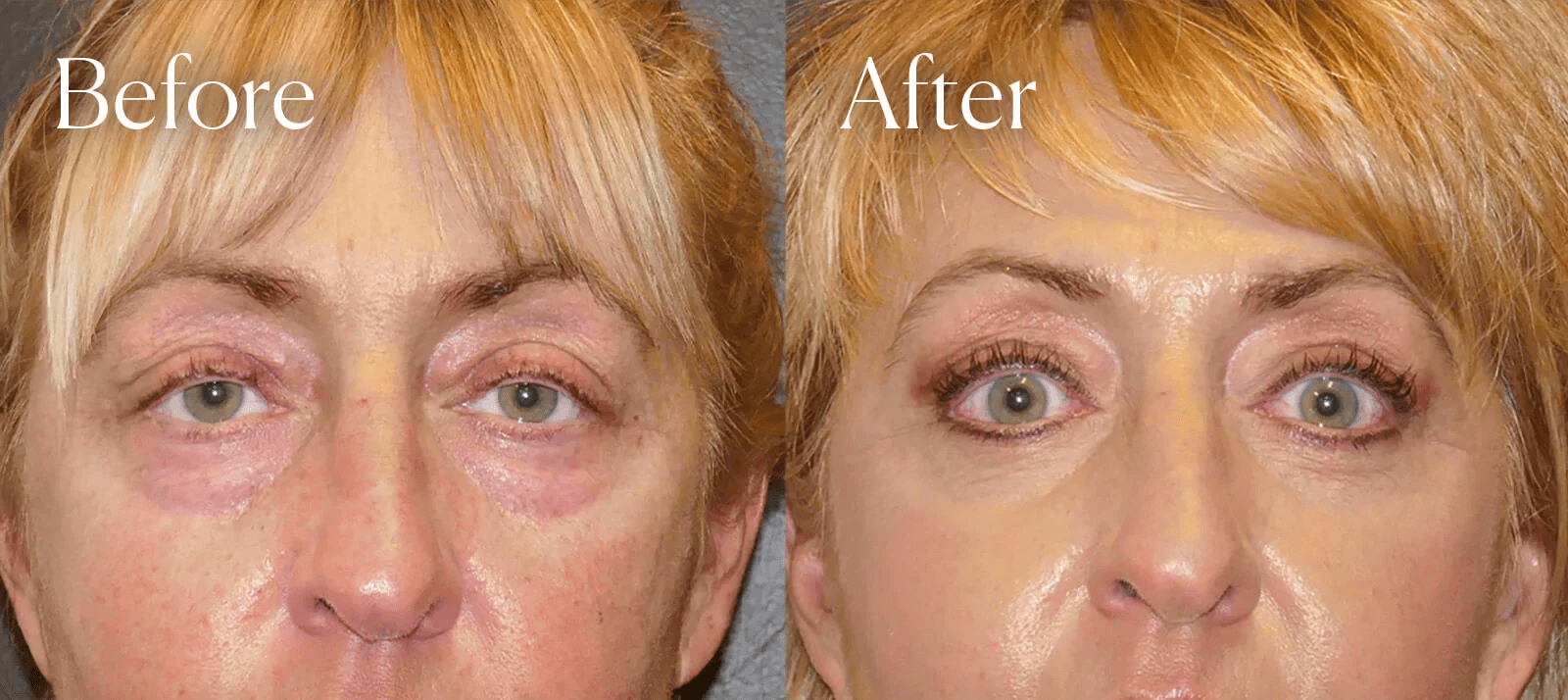 lower eyelid lift plastic surgery