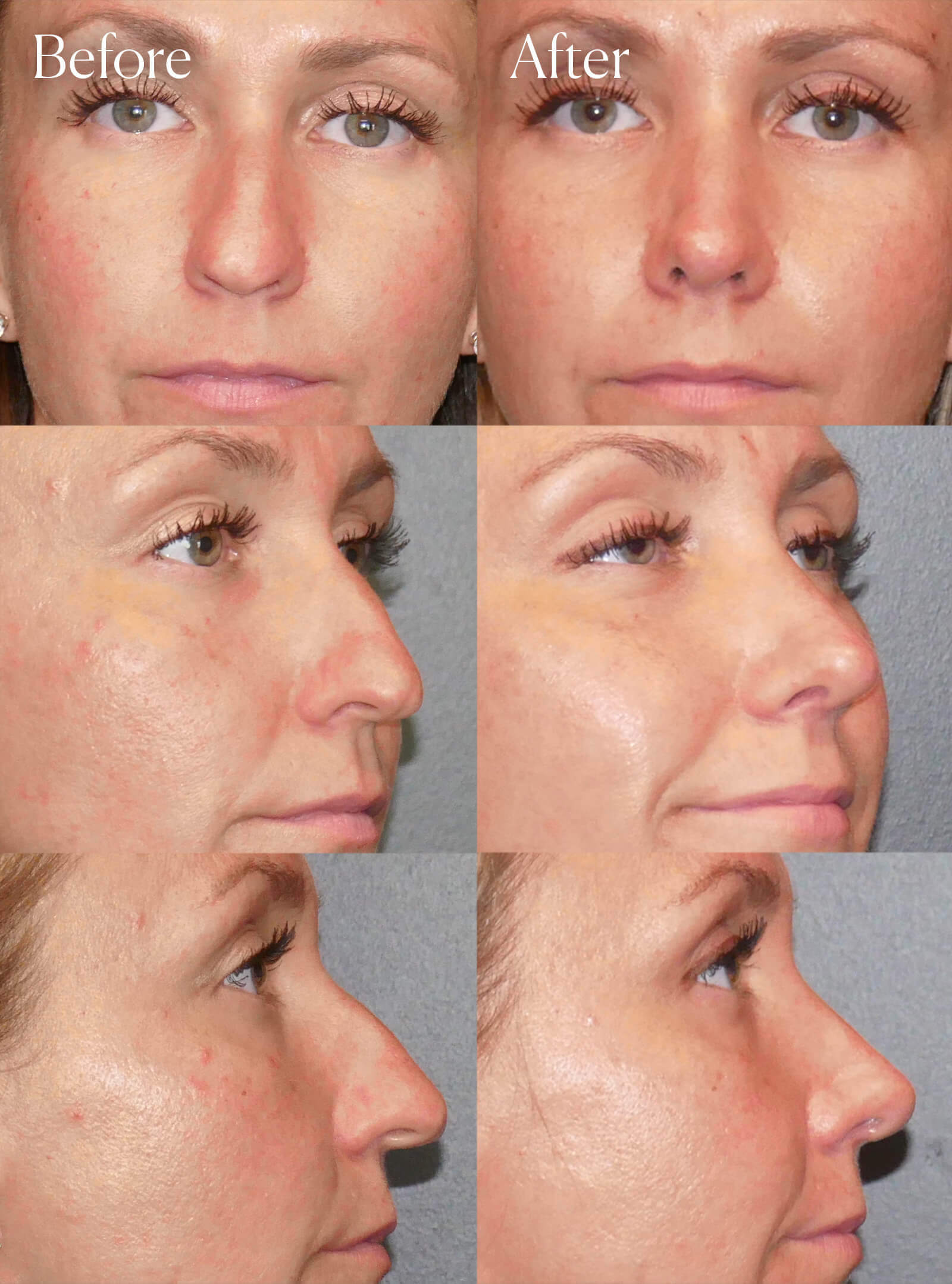 preservation ultrasonic rhinoplasty aesthetic surgery