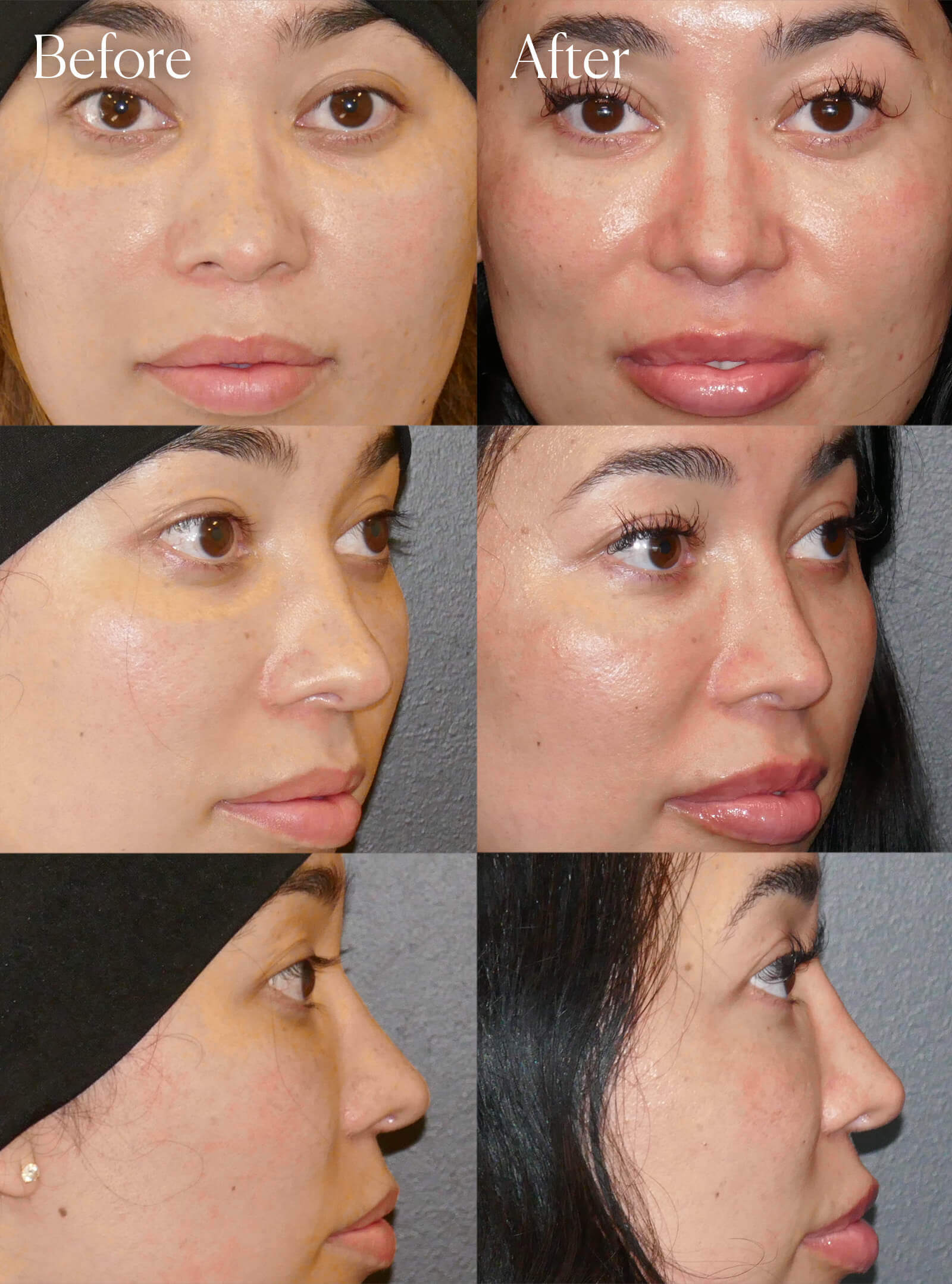 revision ethnic rhinoplasty plastic surgery