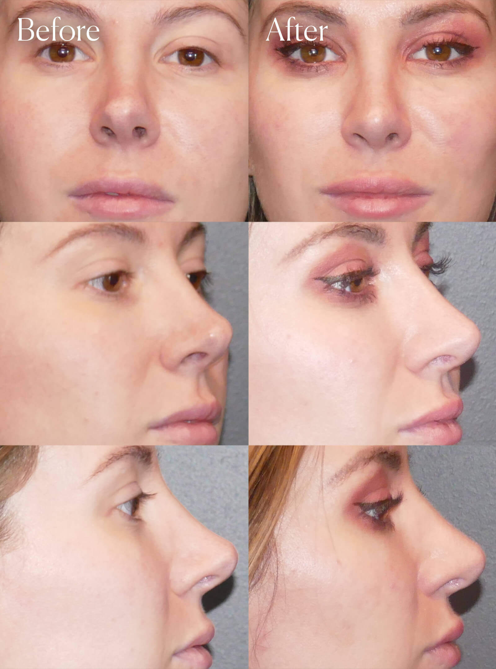 revision rhinoplasty before and after